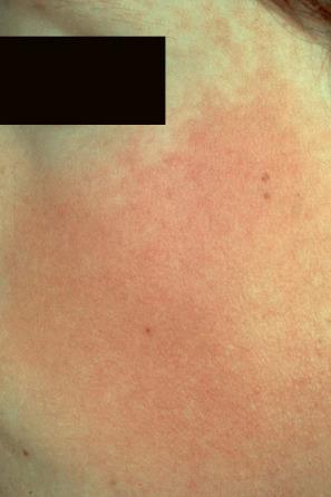 Fig. 3.68, Ulerythema ophryogenes: the cheek is also frequently involved.