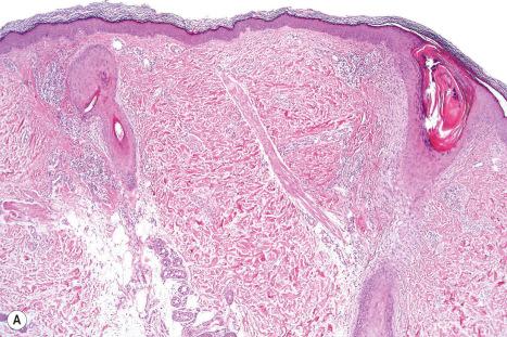 Fig. 3.69, Keratosis pilaris atrophicans: ( A ) low-power view showing gross follicular hyperkeratosis and dilatation of the ostium; ( B ) high-power view. Note the perifollicular fibrosis extending into the reticular dermis.