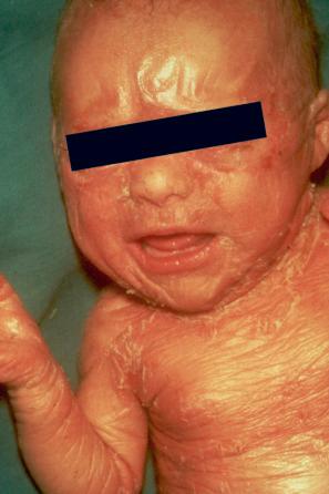 Fig. 3.9, Autosomal recessive congenital ichthyosis: the collodion membrane is best seen on the forehead. There is scaling and erythema on the trunk.