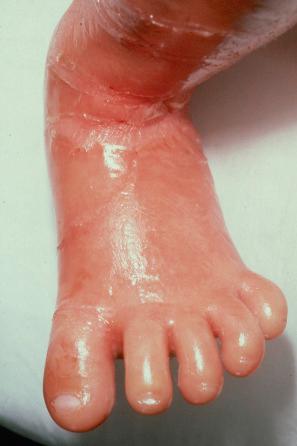 Fig. 3.10, Autosomal recessive congenital ichthyosis: note the erythema. The skin is shiny, taut, and shows fissuring around the anterior aspect of the ankle.