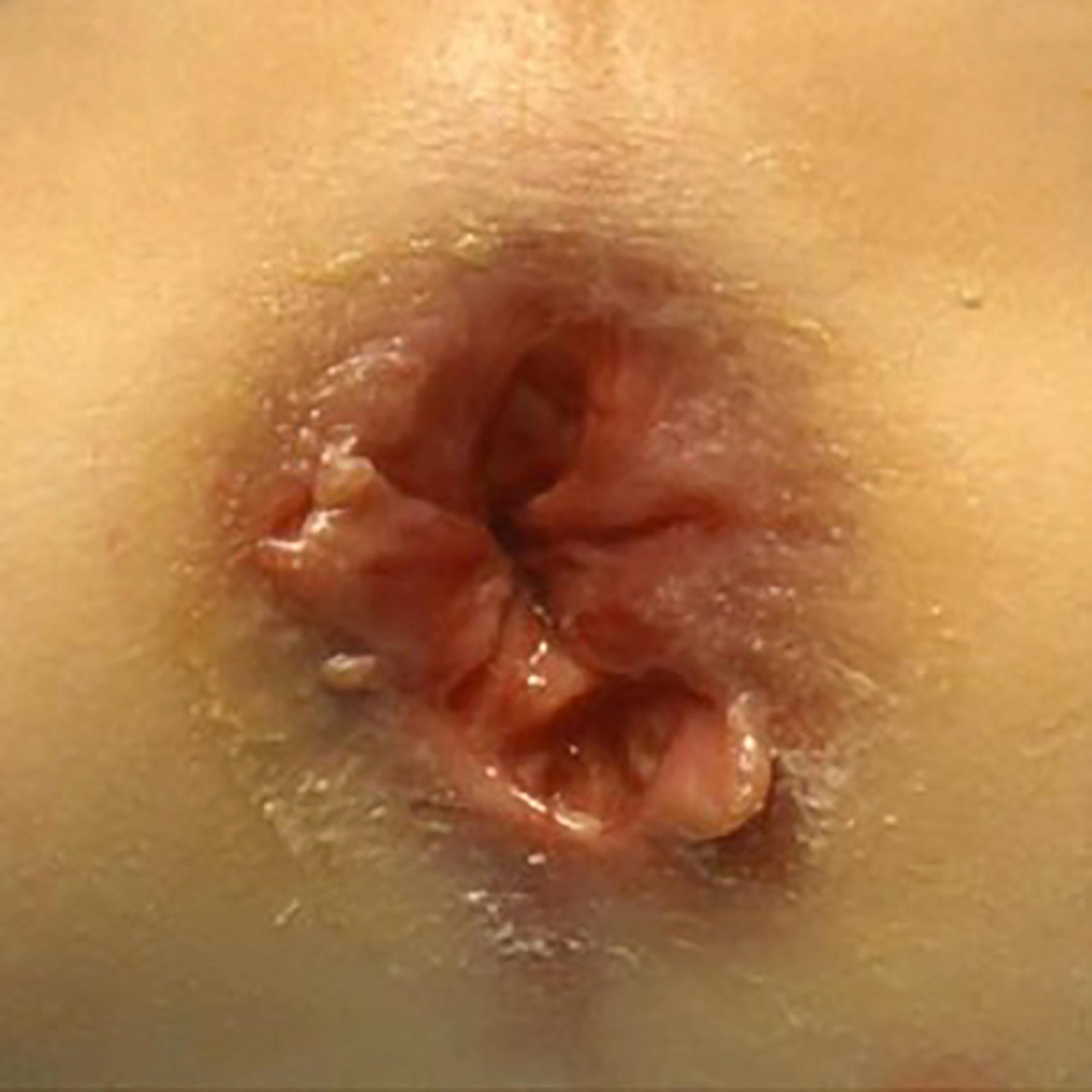 Fig. 46.3, Crohn disease associated anal fissures with undermining of the edges.