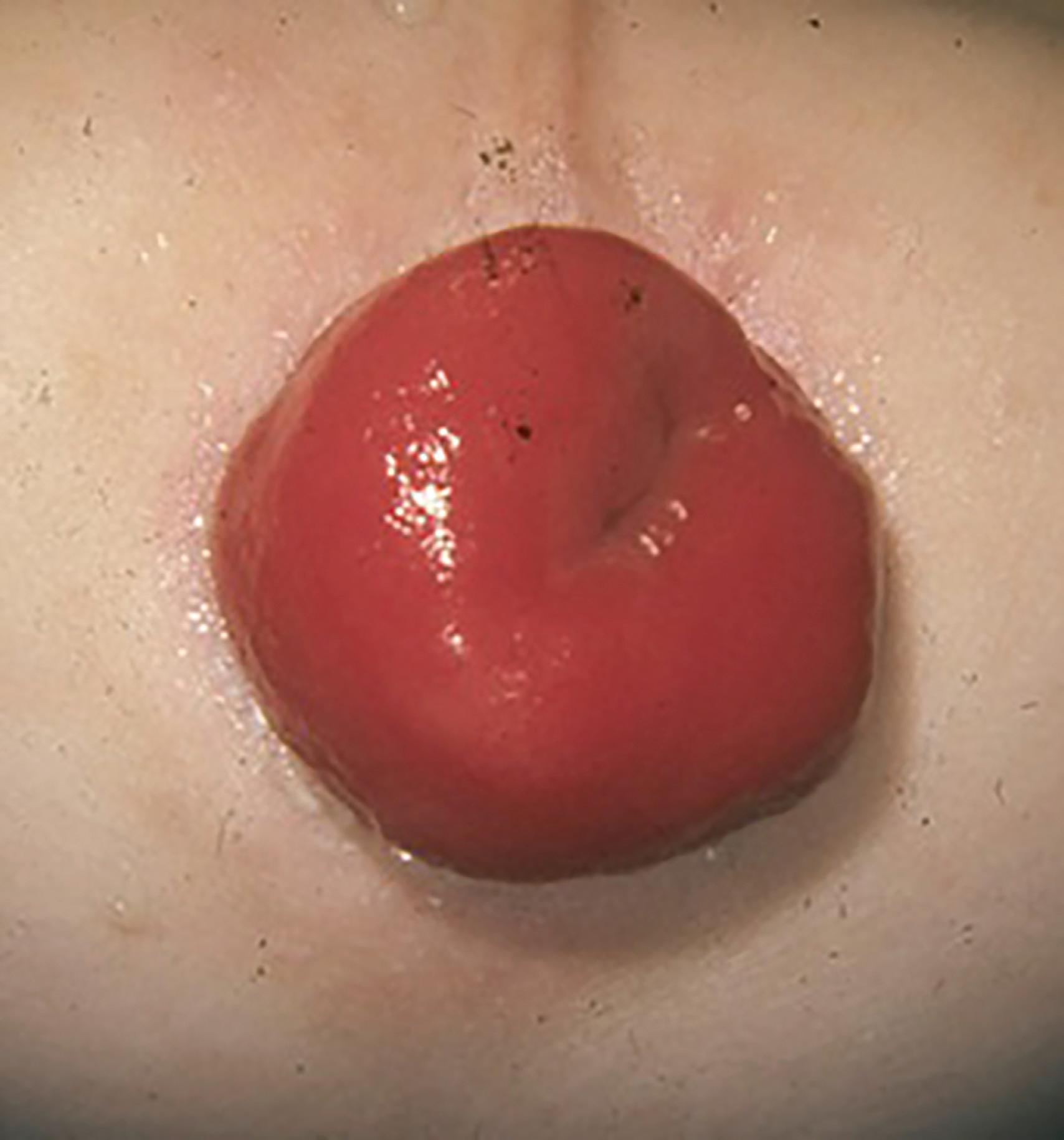 Fig. 46.4, Mucosal Prolapse.