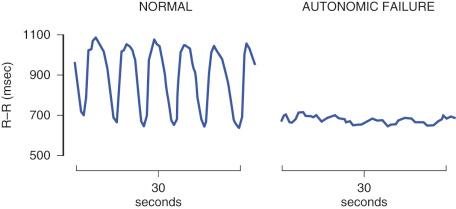 Figure 63-2, Successive electrocardiographic R-R intervals during paced breathing in a normal subject ( left ) and in a patient with autonomic failure ( right ).