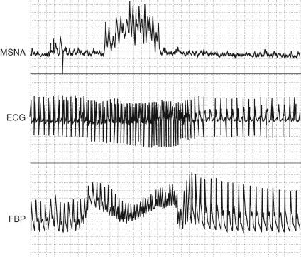 Figure 63-4, Muscle sympathetic nerve activity (MSNA), electrocardiogram (ECG), and finger blood pressure (FBP) during Valsalva maneuver in a normal subject.