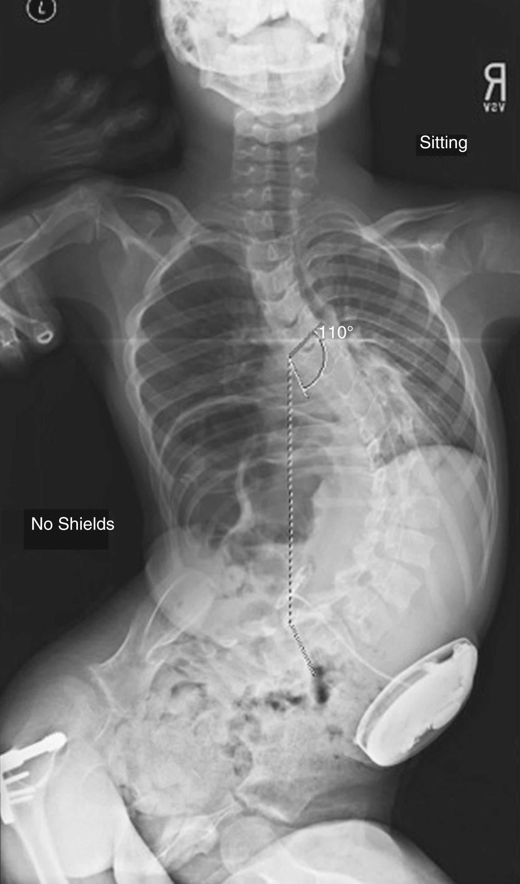 Fig. 31.15, An 11-year-old boy with 110-degree scoliosis, spastic quadriparesis, and an intrathecal baclofen pump. The patient had also undergone left hip reconstruction for subluxation.