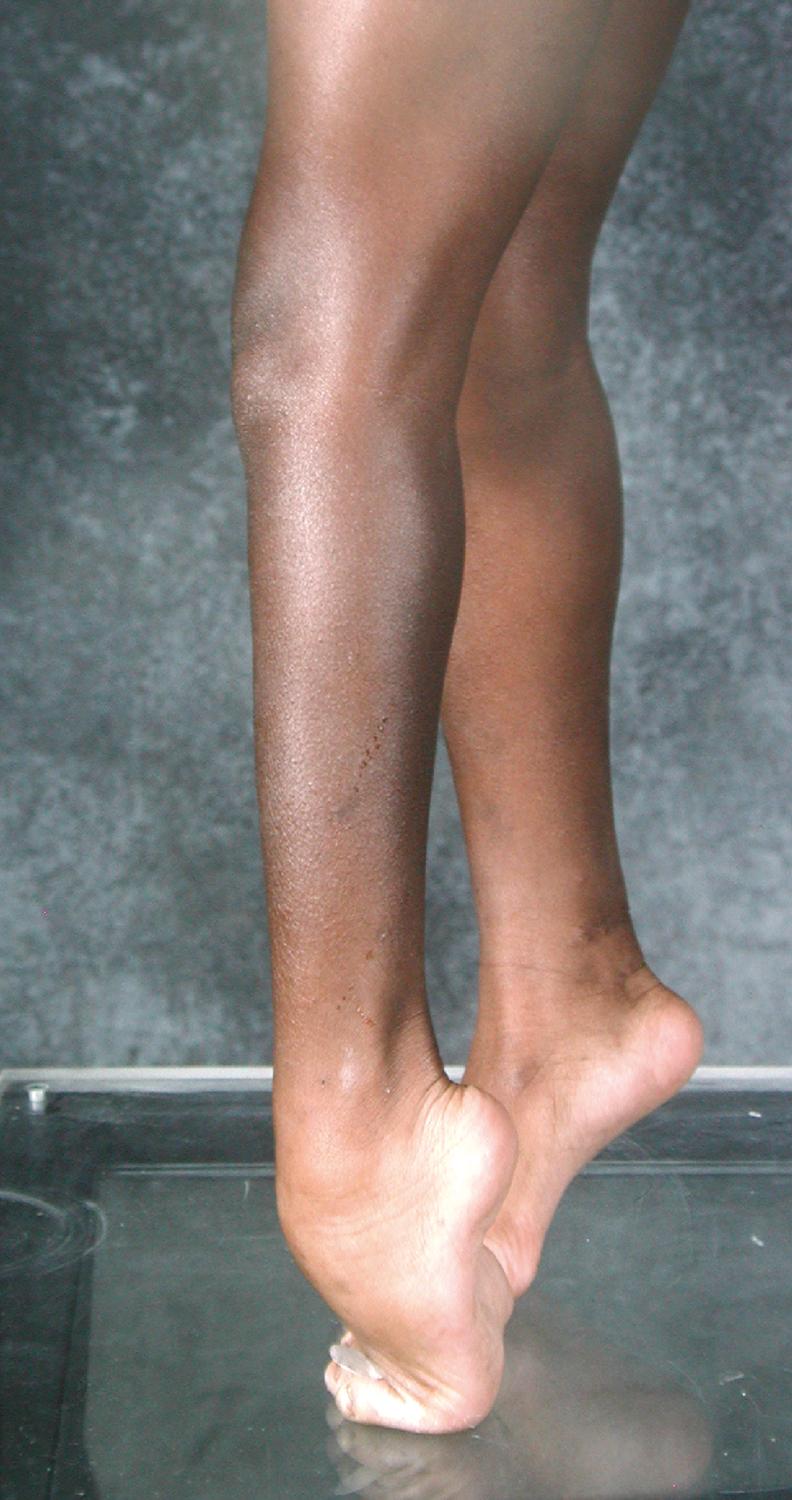 Fig. 31.16, Bilateral severe equinus contracture in a child with cerebral palsy.