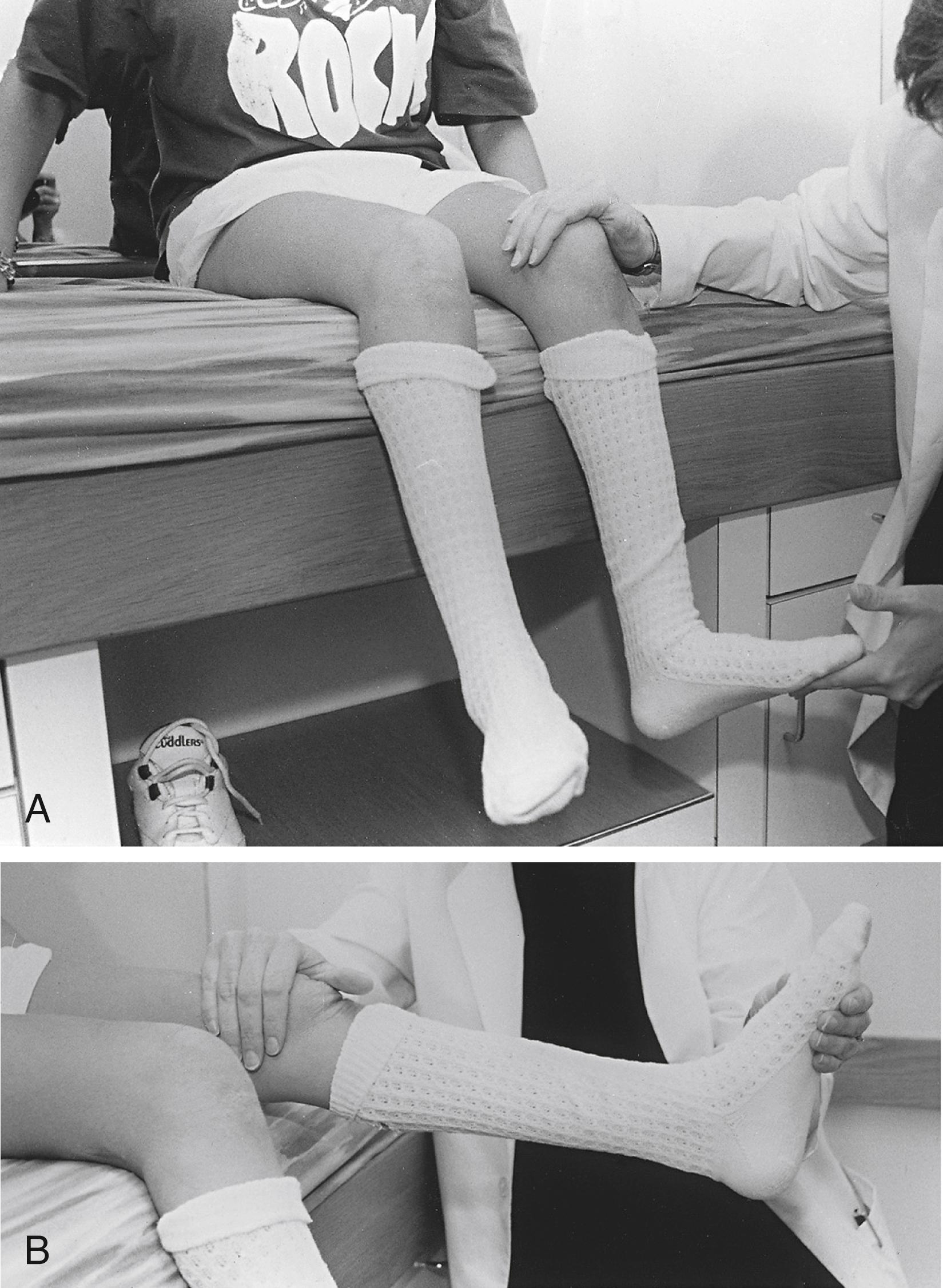 Fig. 31.17, (A and B) Mild ankle equinus in a 17-year-old girl with spastic diplegia. The ankle cannot be dorsiflexed past neutral with the knee extended.