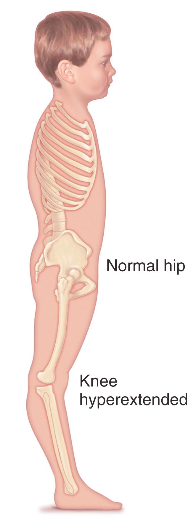 Fig. 31.18, Hyperextension of the knees to compensate for fixed equinus deformity of the ankle. One method of aligning the trunk and bringing the center of gravity over the feet is by knee hyperextension.