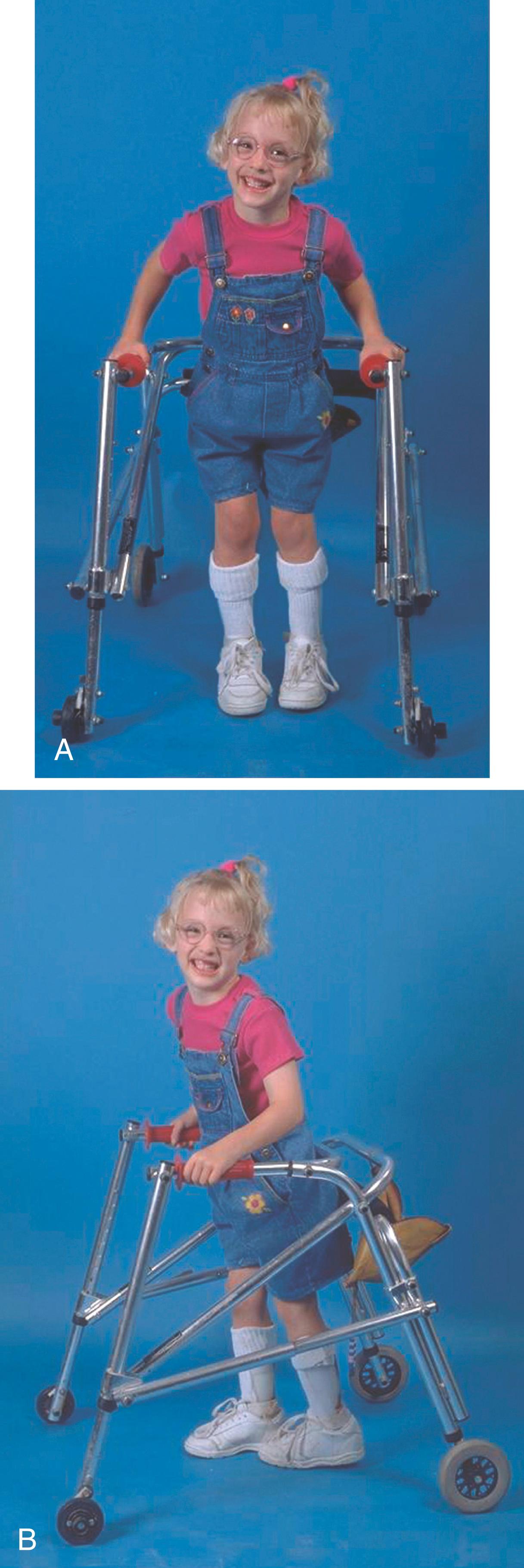 Fig. 31.2, (A and B) A 5-year-old girl with spastic diplegia. She walks with the aid of a walker and bilateral ankle–foot orthoses.