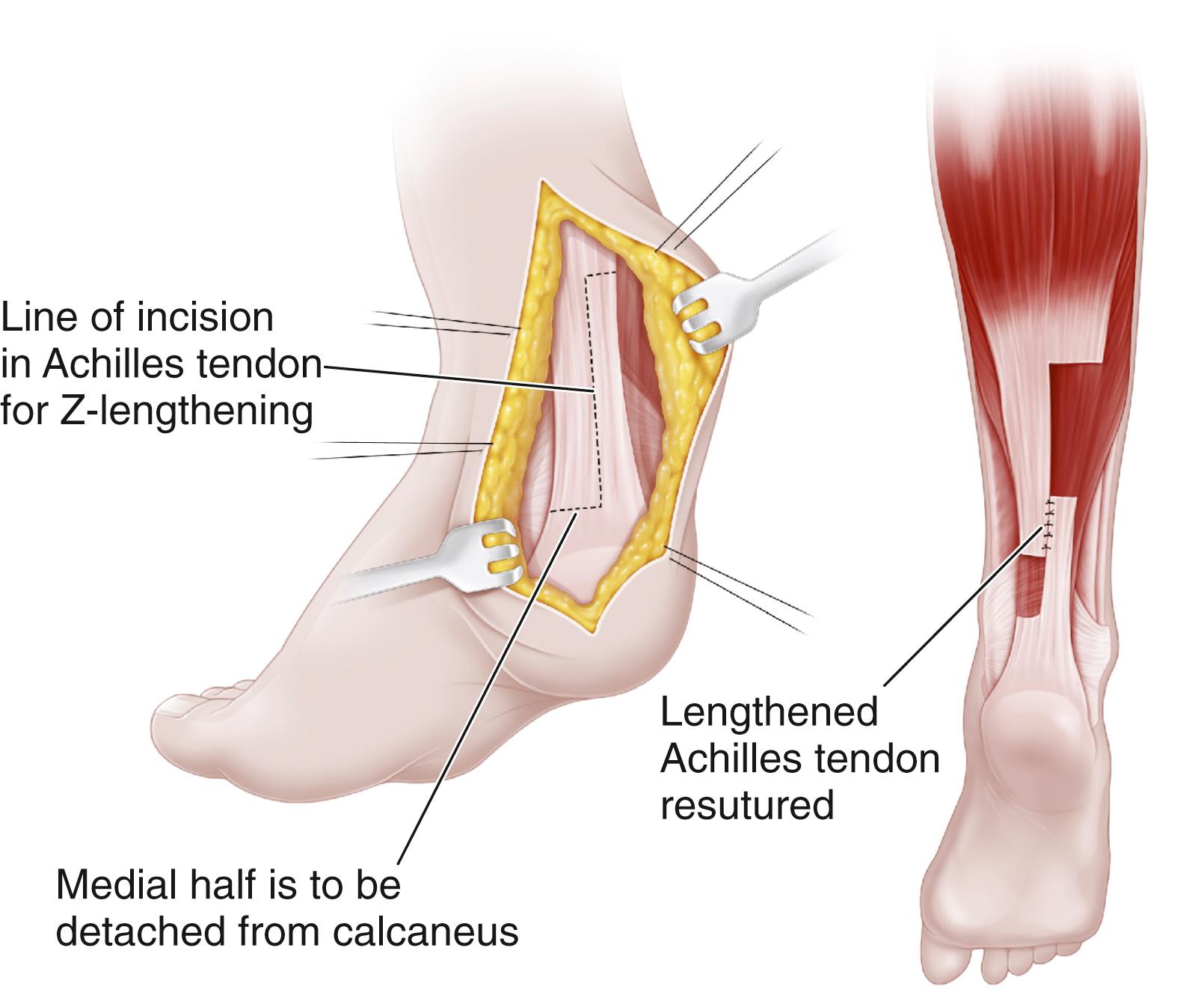 Fig. 31.23, Z-lengthening of the Achilles tendon.