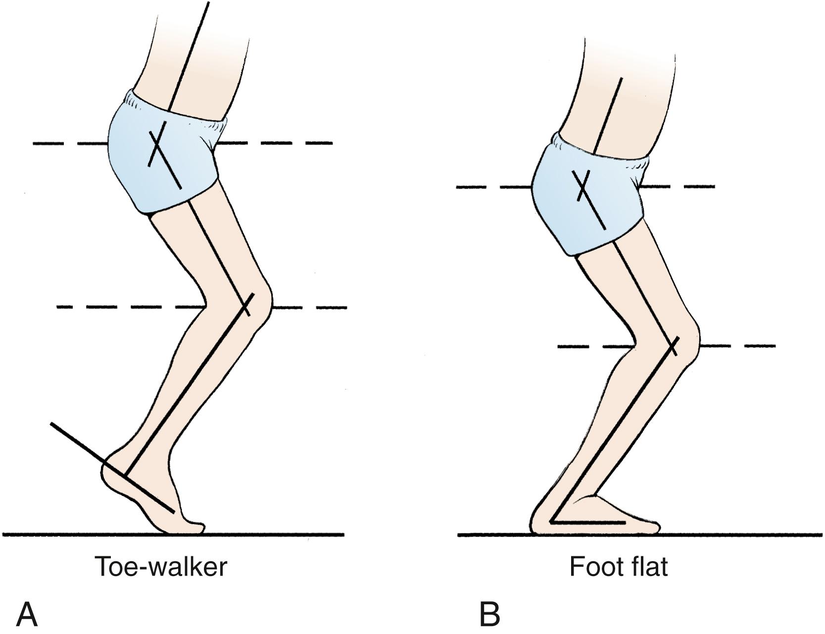 Fig. 31.24, (A) Child with a crouched knee and toe-toe gait. The ankle is actually in neutral position, but the child walks on the toes to compensate for the flexed knee. (B) After inappropriate Achilles tendon lengthening, flexion at the knee remains unchanged and the ankle is now excessively dorsiflexed, which results in a calcaneus gait.