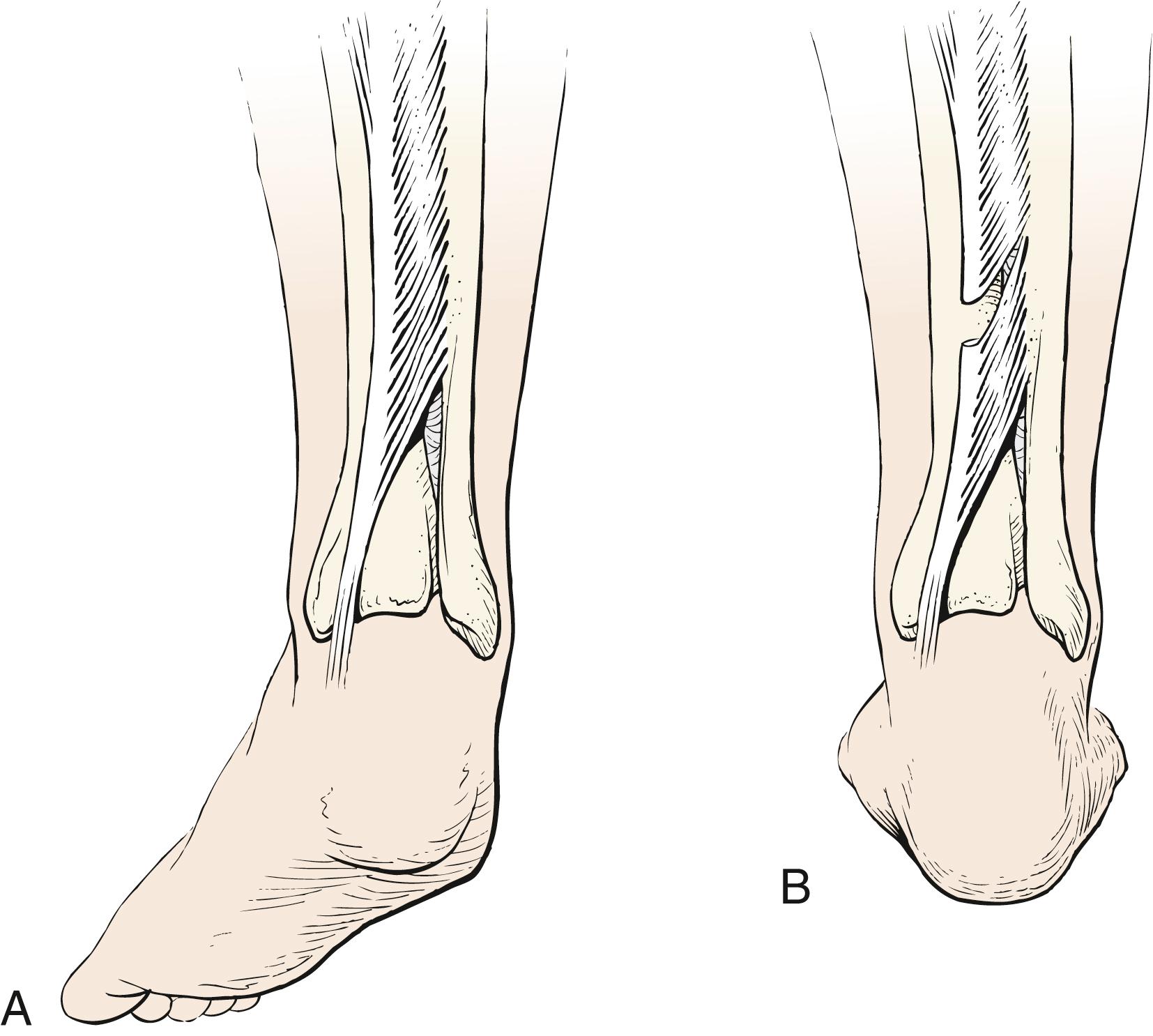 Fig. 31.29, (A and B) Intramuscular lengthening of the posterior tibial tendon can be performed in the distal third of the leg in patients with mild varus deformity.