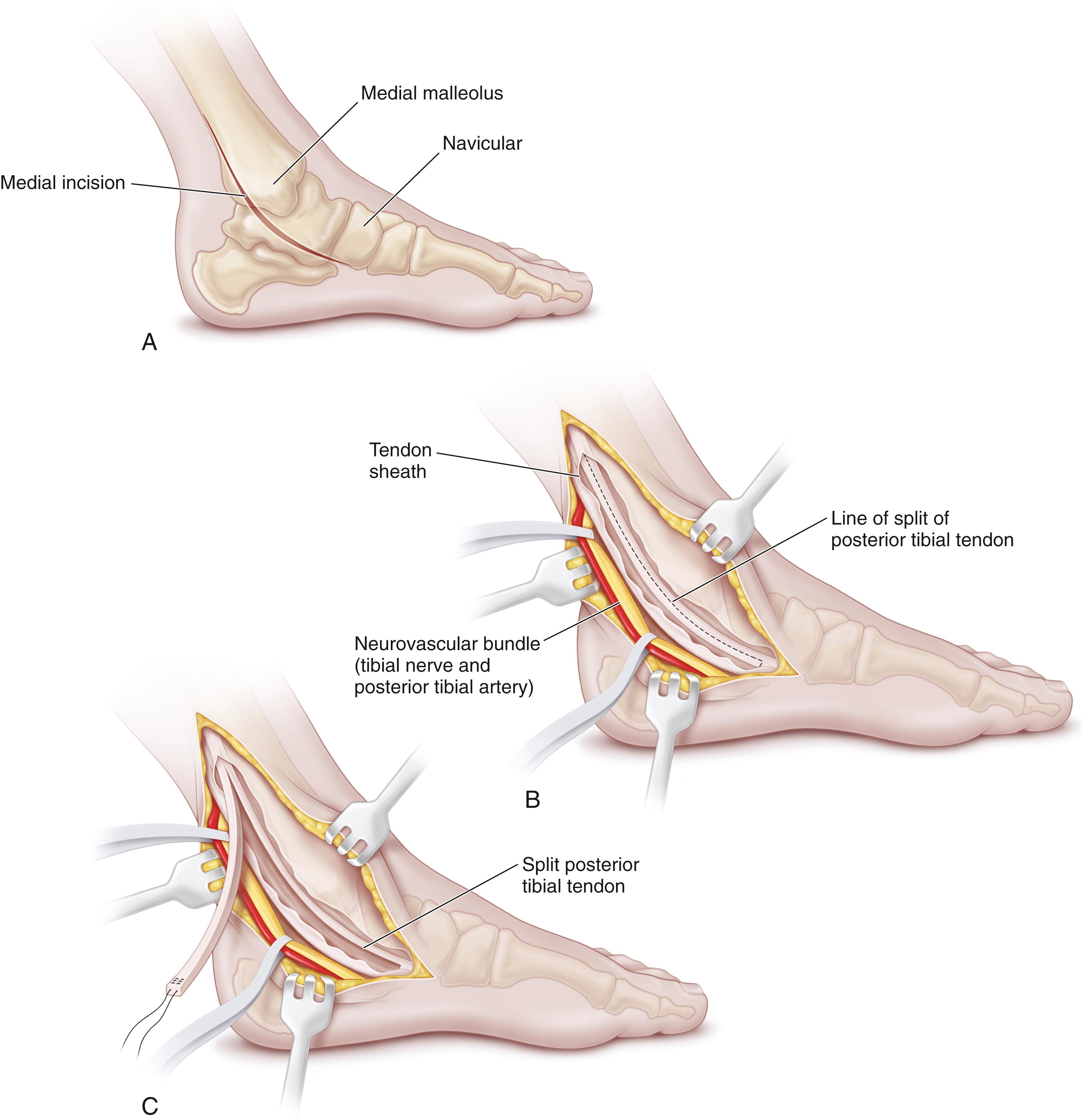 Fig. 31.30, Surgical technique of split posterior tendon transfer. (A) Line of the medial incision. Two smaller incisions may also be used. (B and C) The posterior tibial tendon is split longitudinally and proximally to its musculotendinous junction; the dorsal portion of the tendon is left intact and attached to the navicular. The retinaculum of the ankle is not divided. Note that the neurovascular bundle and long toe flexors are gently retracted posteriorly.