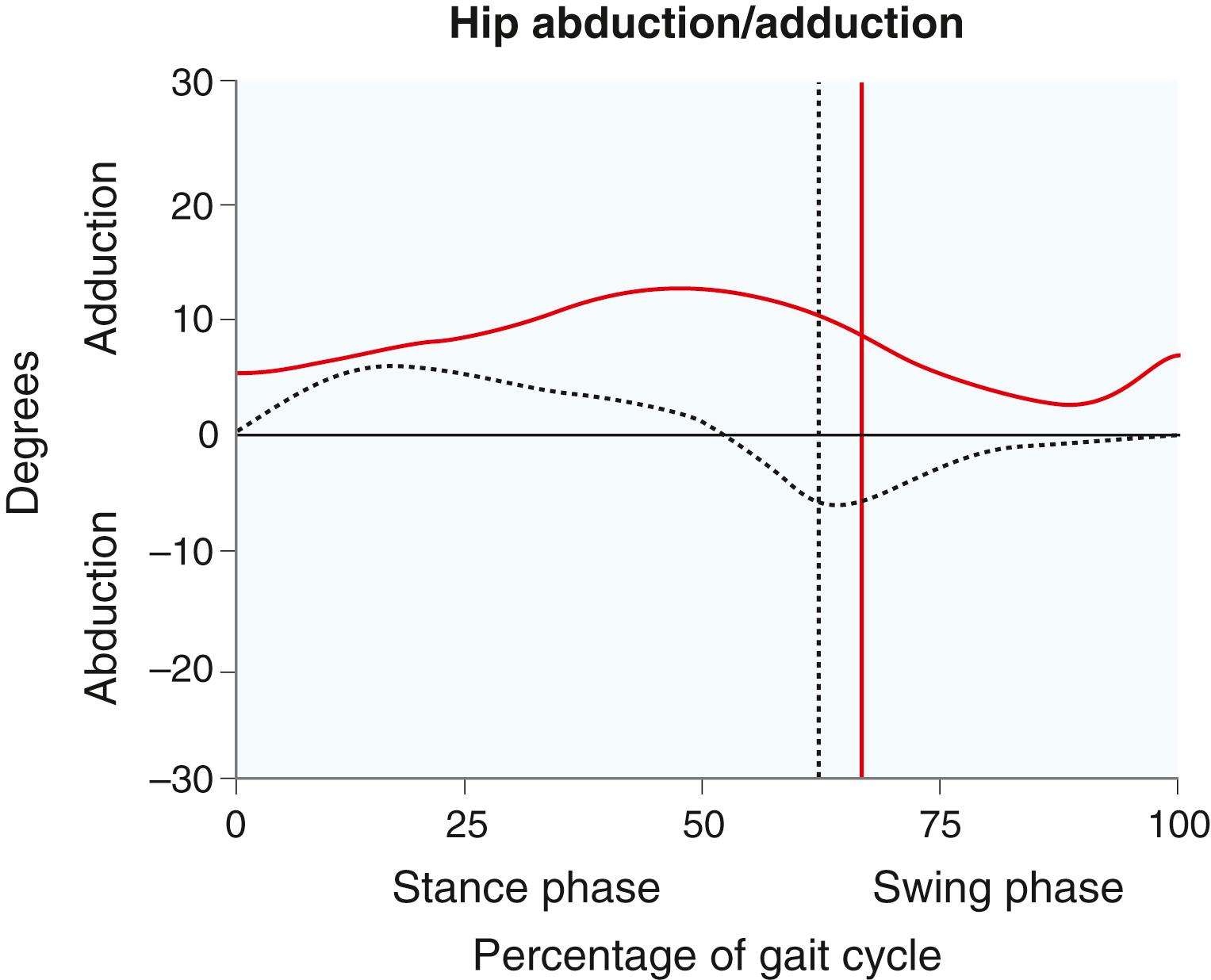 Fig. 31.5, In normal gait (black dotted curve) , the hip adducts slightly in stance phase as the contralateral hemipelvis drops, and it abducts slightly in swing phase. In patients with scissoring as a result of cerebral palsy (red curve) , adduction of the hip is increased. Vertical lines designate divisions between the stance and swing phases for each leg.