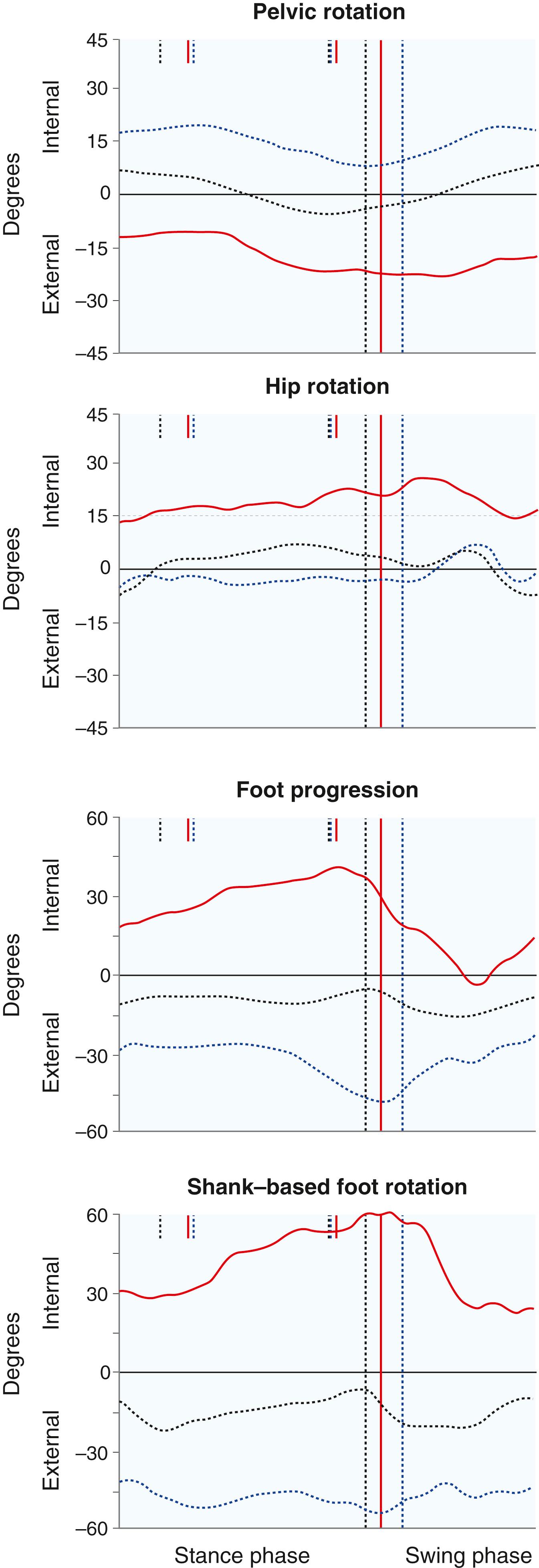 Fig. 31.7, Transverse-plane kinematics is useful in determining the cause of intoeing or outtoeing in cerebral palsy. In this hemiplegic patient, the involved hemipelvis is characteristically externally rotated (red curves) , excessive femoral anteversion is present, and the foot is internally rotated relative to the knee because of equinovarus deformity of the foot. This results in a foot progression angle of 40 degrees internally. The uninvolved side is represented by the blue dotted curves , and normal transverse-plane kinematics is represented by the black dotted curves . Vertical lines designate divisions between the stance and swing phases for each leg.