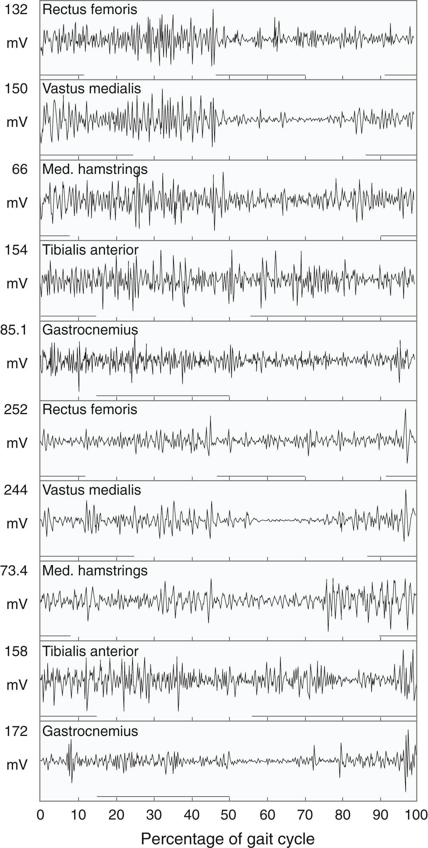 Fig. 31.10, Typical electromyographic pattern during gait in a child with cerebral palsy. The horizontal bars represent the situation in which a muscle is normally “on.” Stance phase is represented from 0 to 60 and swing phase from 60 to 100. Contraction of all muscles is inappropriate during gait.