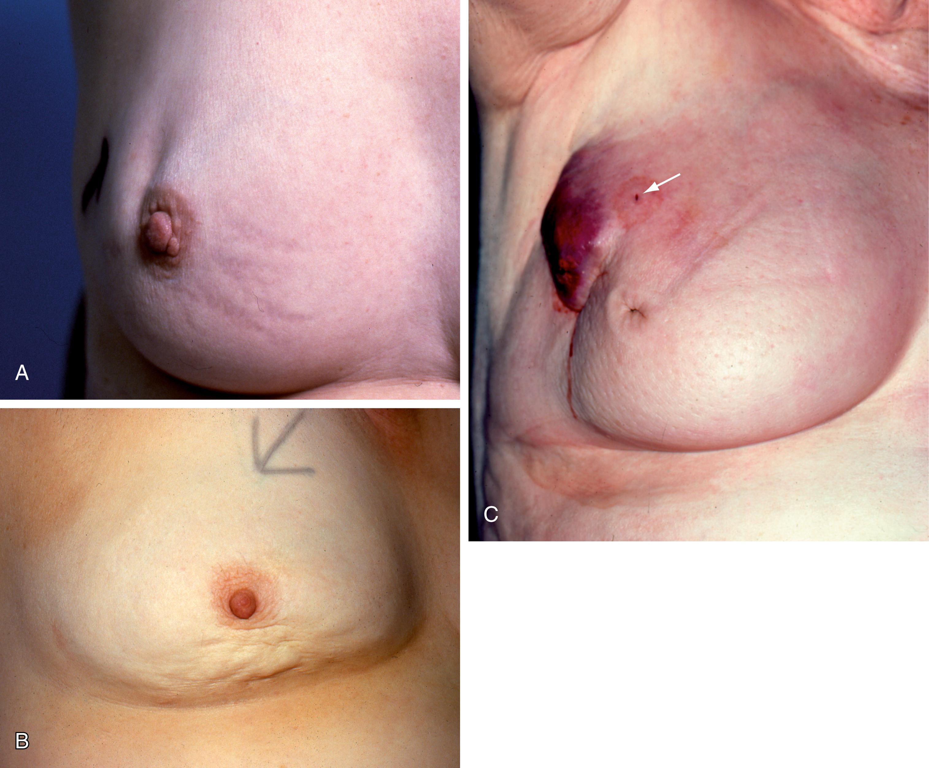 Fig. 45.4, Carcinoma of the Breast.