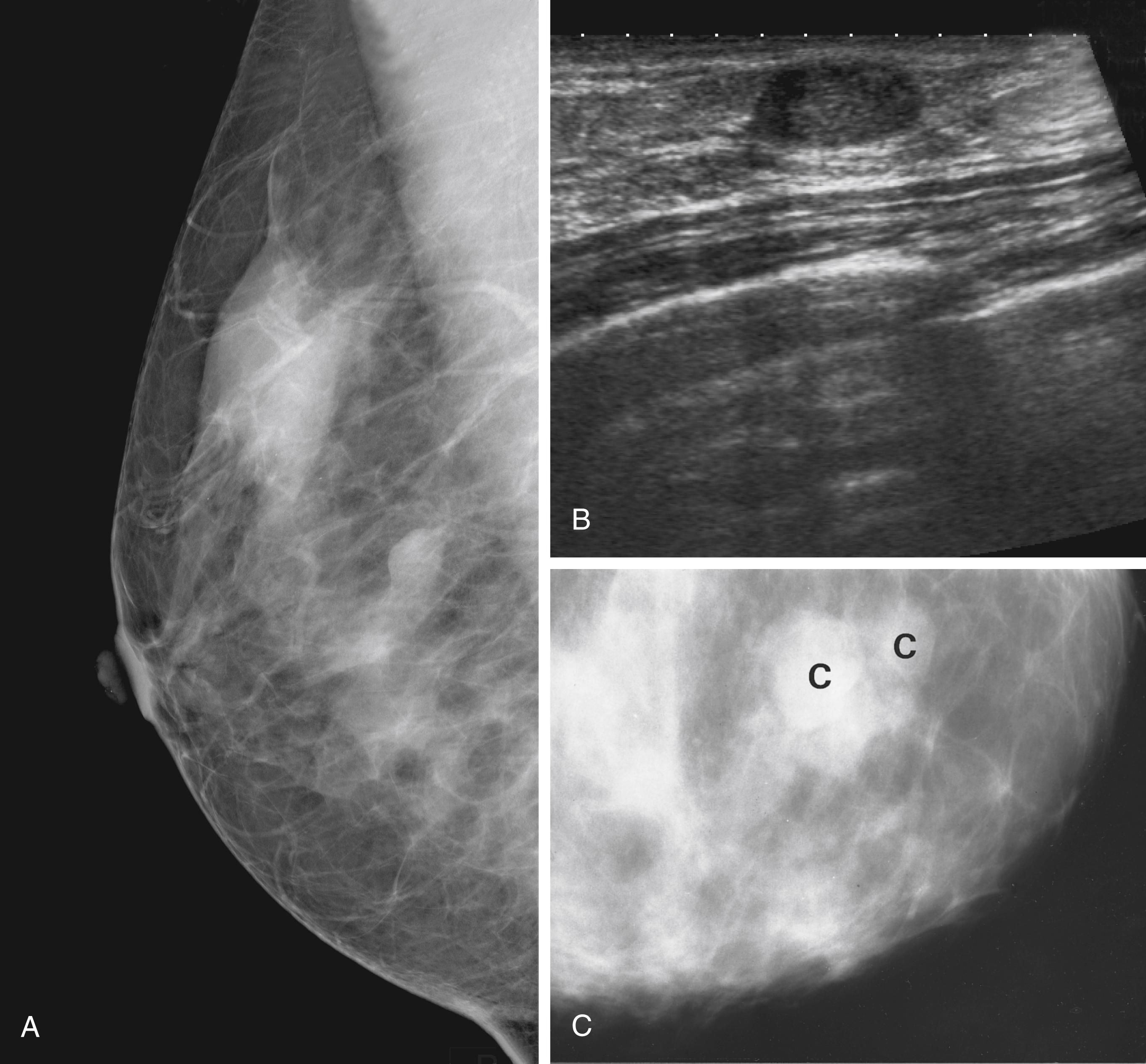 Fig. 45.6, Fibroadenoma of the Breast.