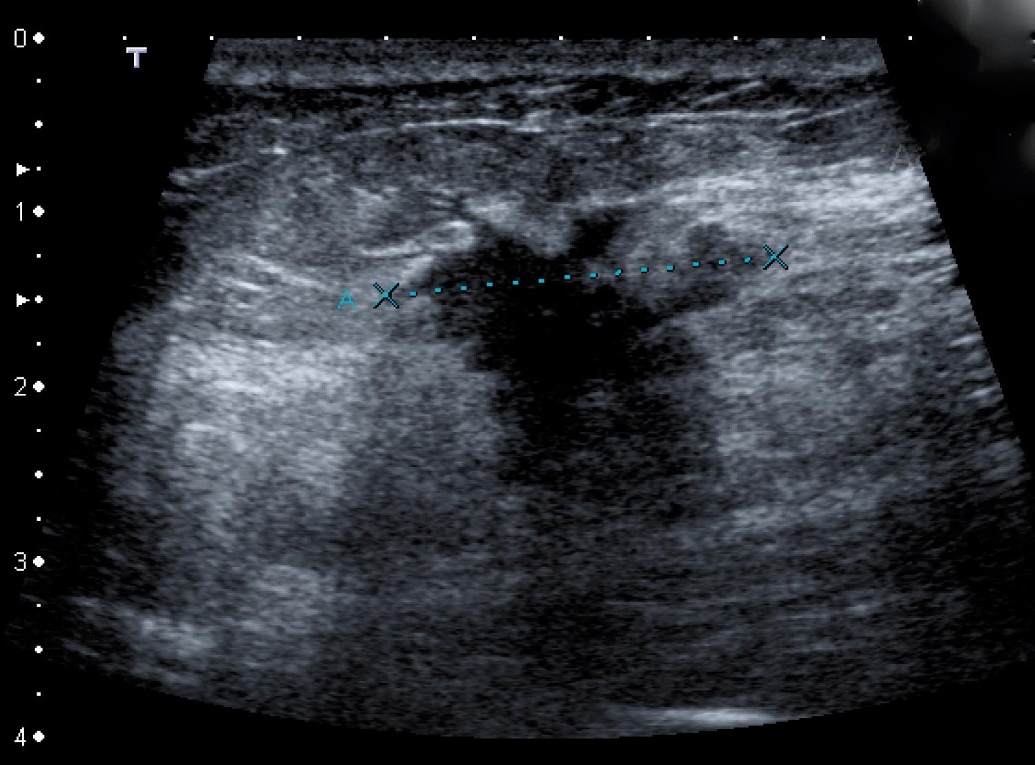 Fig. 45.7, Carcinoma of the Breast on Ultrasound.