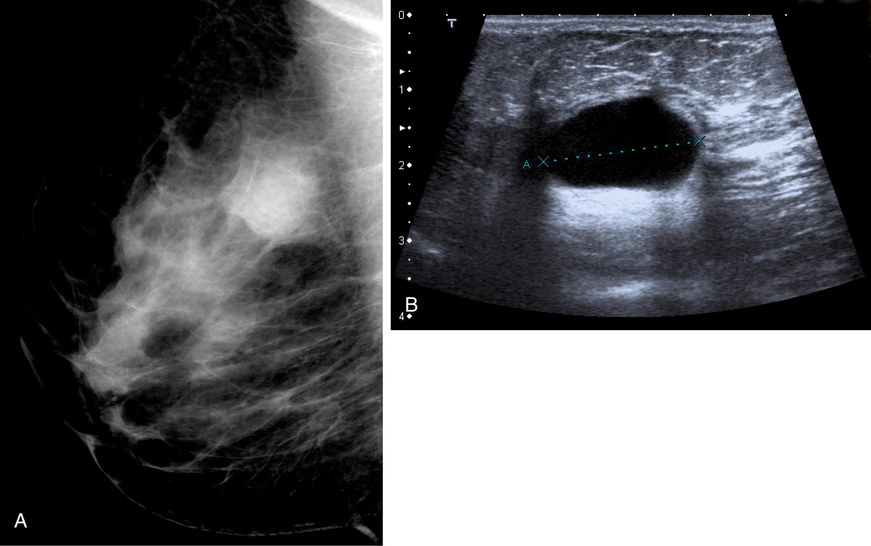 Fig. 45.8, Breast Cyst.