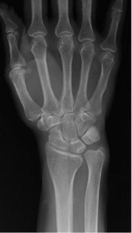 Fig. 72.3, A posteroanterior wrist view showing significant ulnar positive variance.