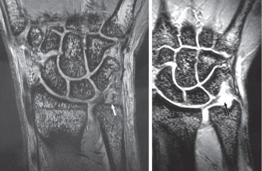 Fig. 72.4, Magnetic resonance imaging cuts showing a class IB triangular fibrocartilage complex (TFCC) tear.