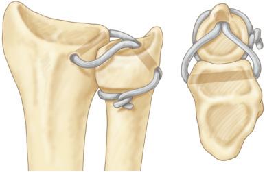 Fig. 72.6, Tendon graft reconstruction to stabilize the distal radioulnar joint.