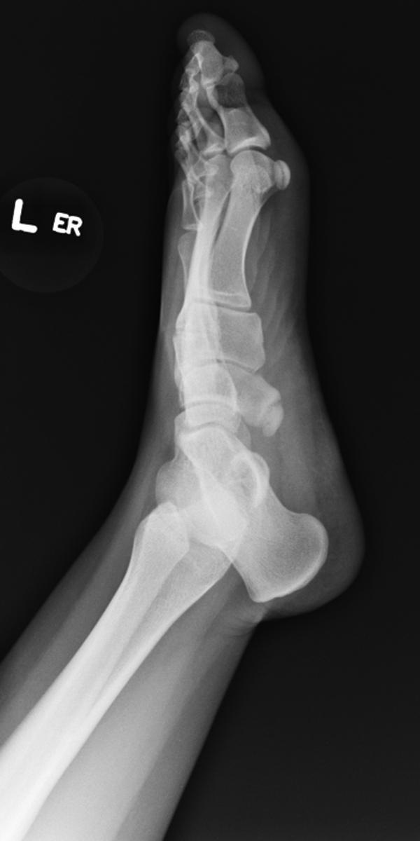 Fig. 19.11, External oblique view sowing a type II accessory navicular.