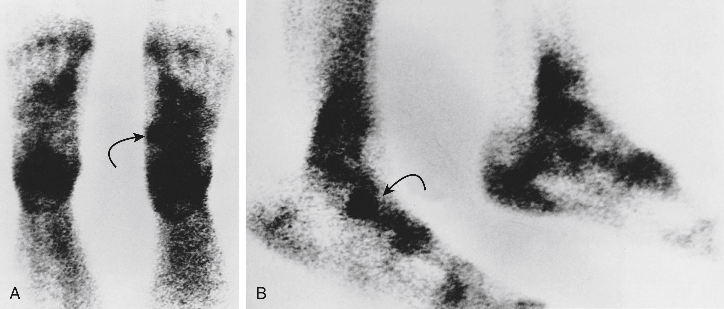 Fig. 19.12, Accessory navicular. (A and B) Technetium bone scans demonstrating increased tracer uptake in the symptomatic right foot (arrows) versus the asymptomatic left foot.