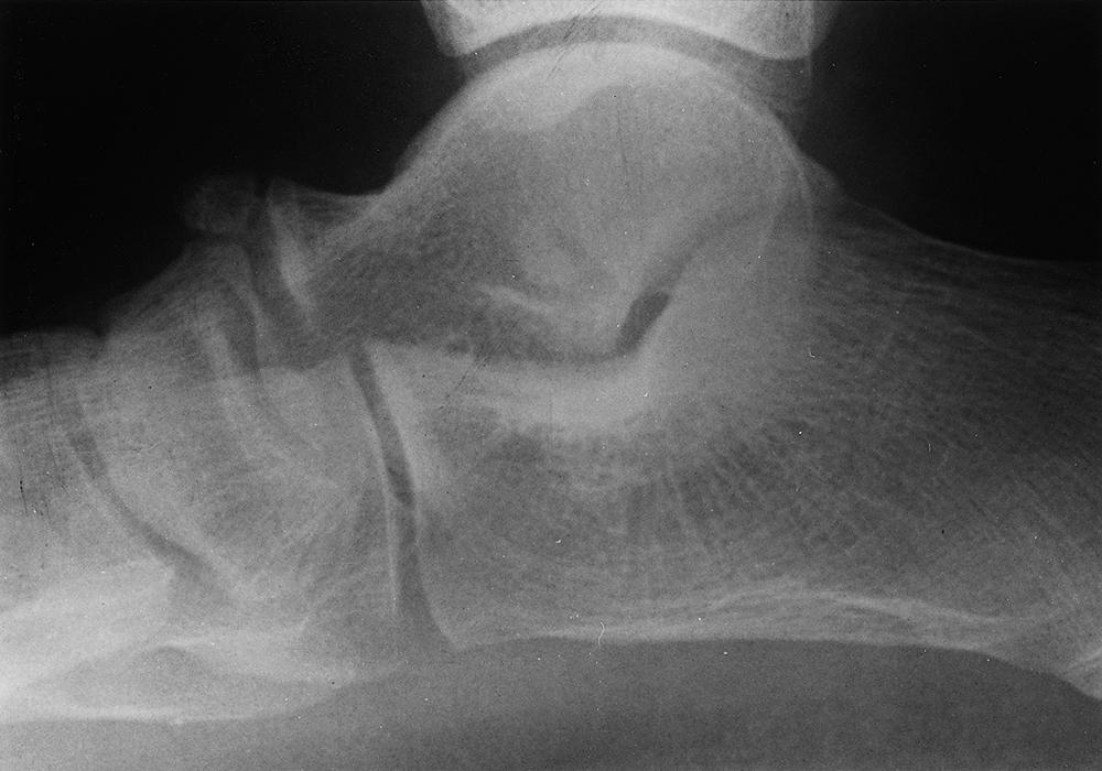 FIG. 19.13, Lateral radiograph showing a bipartite navicular articulating with the talus.