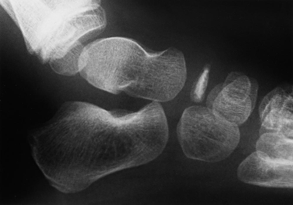 FIG. 19.15, Köhler disease. Lateral radiograph of the 4-year-old girl’s left foot showing apparent compression of the navicular.