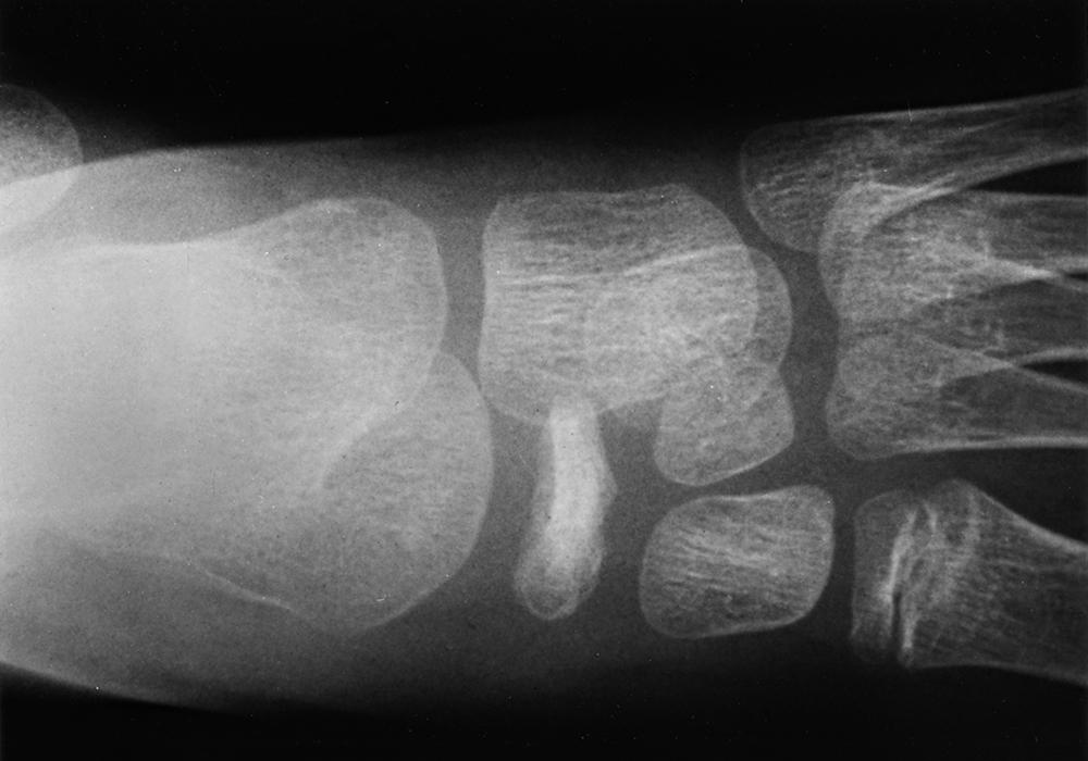 FIG. 19.16, Anteroposterior radiograph of the navicular obtained 1 year following conservative treatment showing partial reconstitution of the navicular with reduced sclerosis. This will eventually undergo full healing.