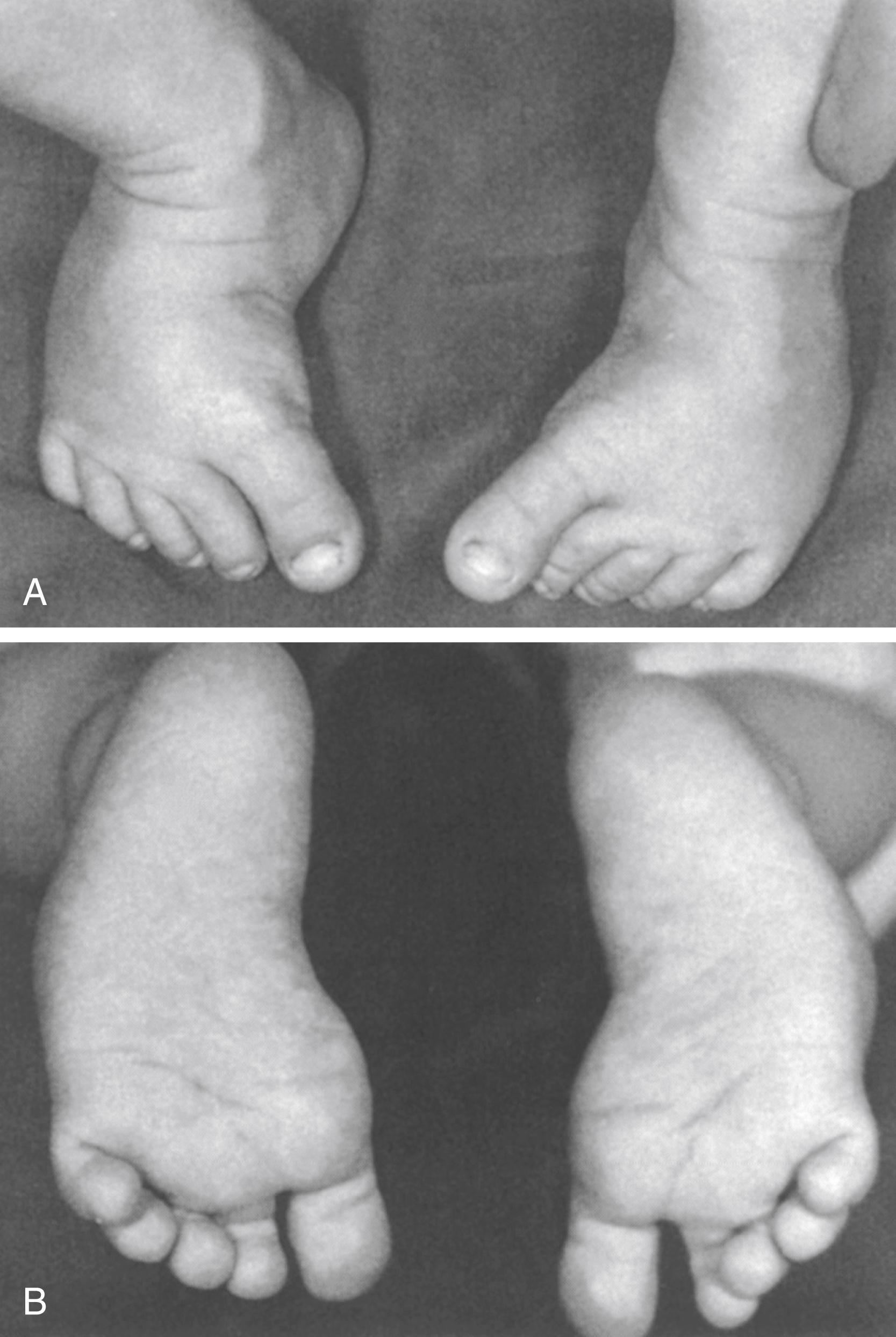 FIG. 19.19, Bilateral mild metatarsus adductus. (A) Dorsal view showing medial deviation of all the metatarsals. (B) Plantar view showing the “bean-shaped” foot. This type of foot is easily corrected with serial casting.