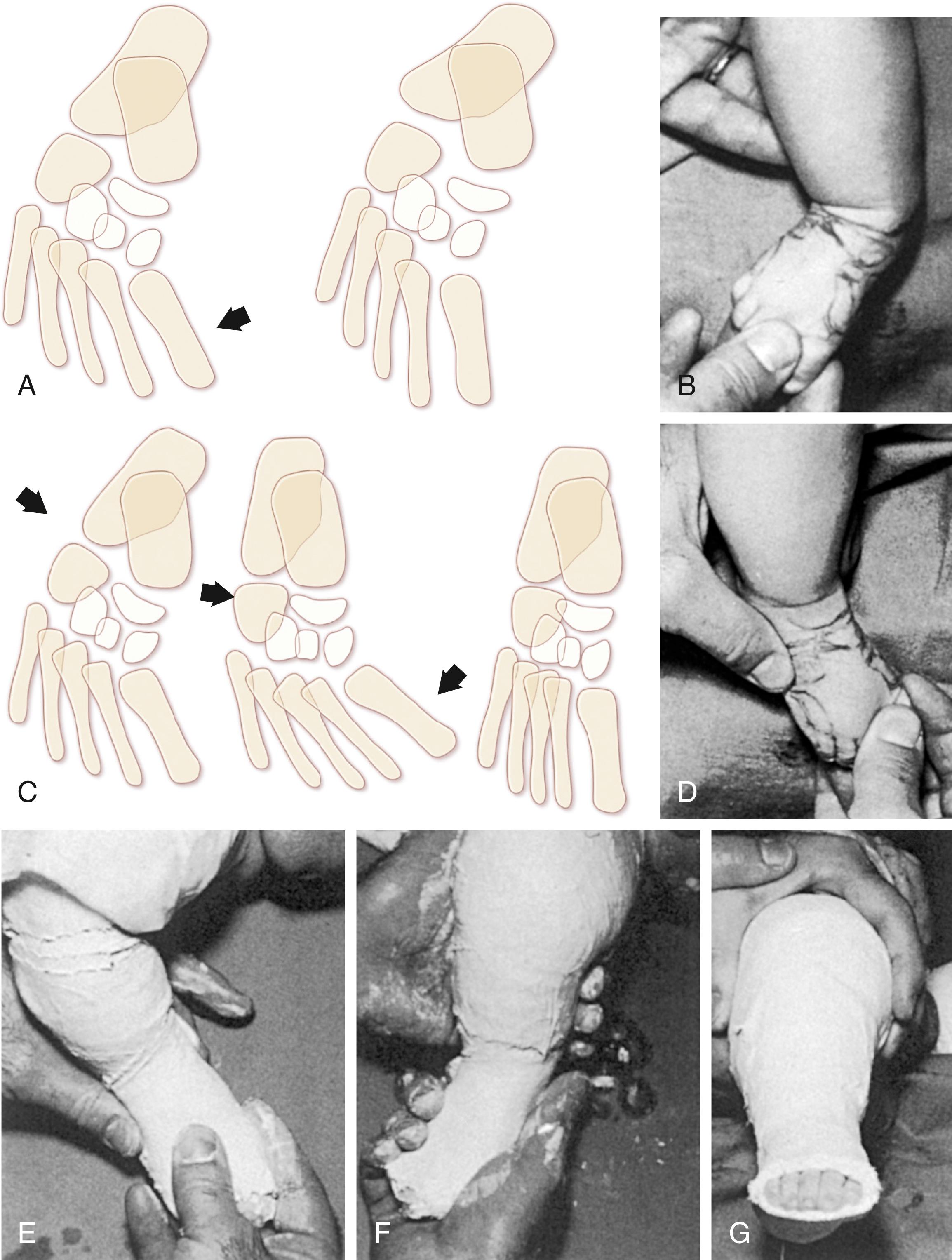 FIG. 19.21, Correction of metatarsus adductus by passive stretching. Arrows indicate the point of application of corrective forces. (A and B) Incorrect method of manipulation. The entire foot is abducted and everted by forcefully abducting and everting the forefoot without applying counterpressure to the hindfoot. The foot is simply twisted at the ankle, with little corrective force exerted at the metatarsotarsal joints. The diagram illustrates how the valgus deformity of the heel is increased and shows that the improved appearance of the varus deformity of the forepart of the foot is spurious and not real correction. (C and D) Correct method of manipulation. The hindfoot is slightly plantar flexed, and the anterior process of the talus is displaced medially underneath the head of the talus; the metatarsals are pushed into abduction while counterpressure is applied over the cuboid. The diagram illustrates the proper method. (E) The foot points somewhat medially while the first section of the plaster cast is applied. (F) The foot and leg are in slight external rotation while the second section of the plaster cast is applied. (G) Completed plaster cast. The heel and anterior part of the foot are immobilized in a position as near normal as possible.