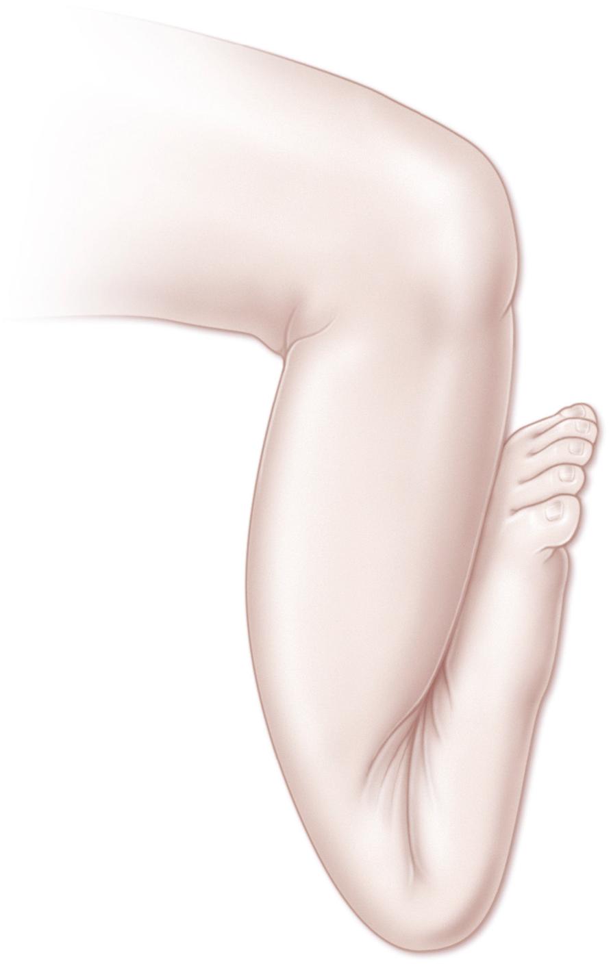 FIG. 19.23, Severe talipes calcaneovalgus in a newborn. Note the foot “plastered” up against the anterior aspect of the tibia. The clinician should always examine the hips to rule out congenital dislocations.