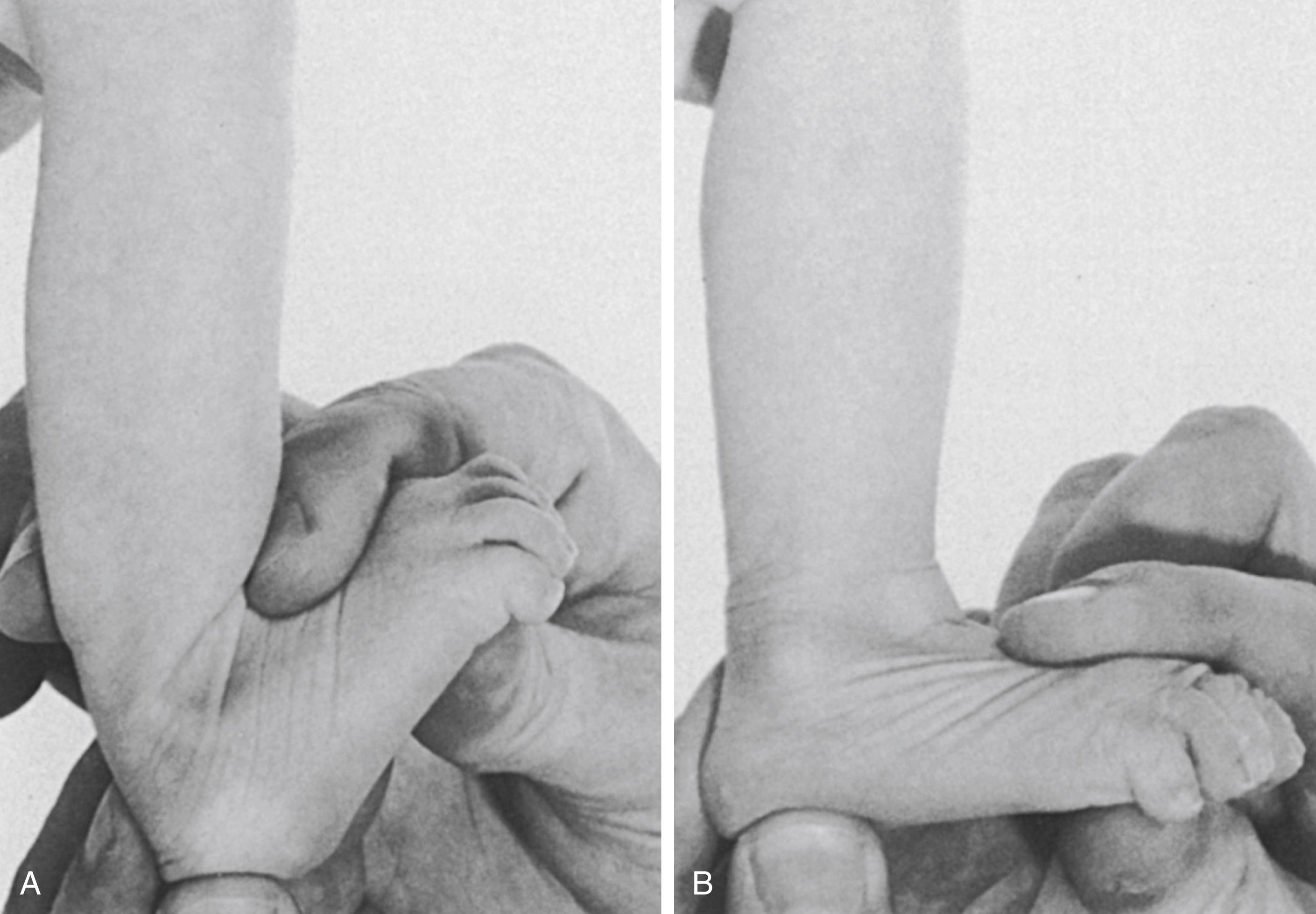 FIG. 19.24, Talipes calcaneovalgus in an infant. (A) The foot is dorsiflexed and everted. (B) Plantar flexion is limited to the neutral position.