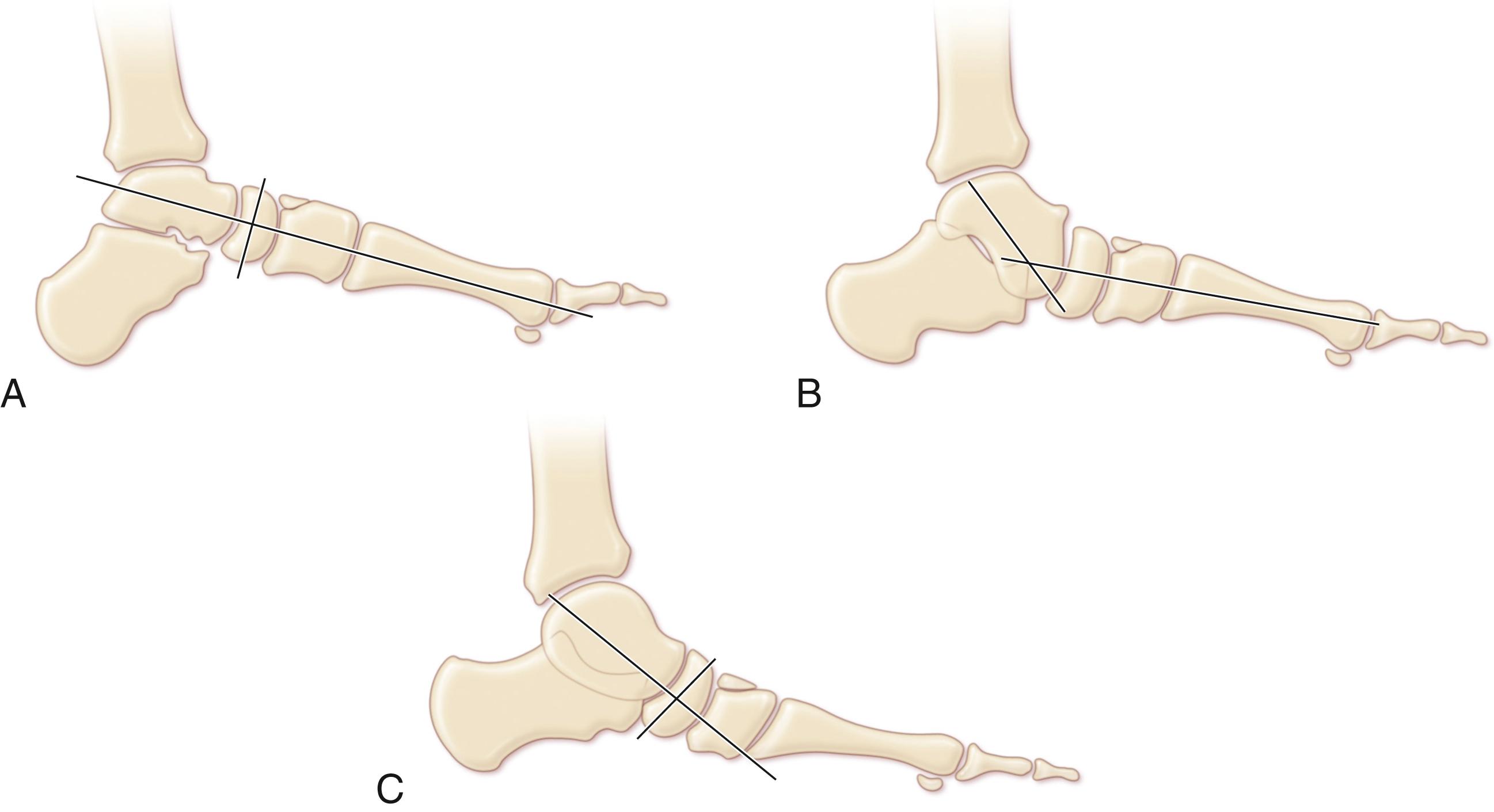 FIG. 19.26, Measurement of Meary angle on a lateral weight-bearing radiograph. (A) A line drawn through the longitudinal axis of the talus, and the first metatarsal is essentially straight on a normal foot. (B) In talonavicular sag, the apex is plantarward, with the talar longitudinal axis intersecting only the most inferior tip of the navicular (because of its dorsal subluxation). (C) In naviculocuneiform sag, the apex of the angle is still plantar, but the navicular remains located centrally on the head of the talus.