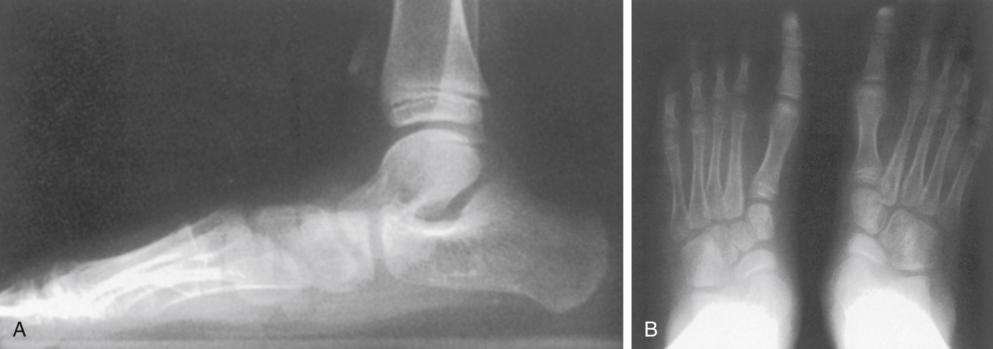 FIG. 19.27, Flatfoot. (A) Standing lateral radiograph. Talonavicular sag and relative plantar flexion of the talus suggest an Achilles tendon contracture. (B) Standing anteroposterior radiographs showing marked hindfoot and midfoot eversion and valgus as suggested by the divergent talocalcaneal axes and the lateral displacement of the navicular on the talar head.