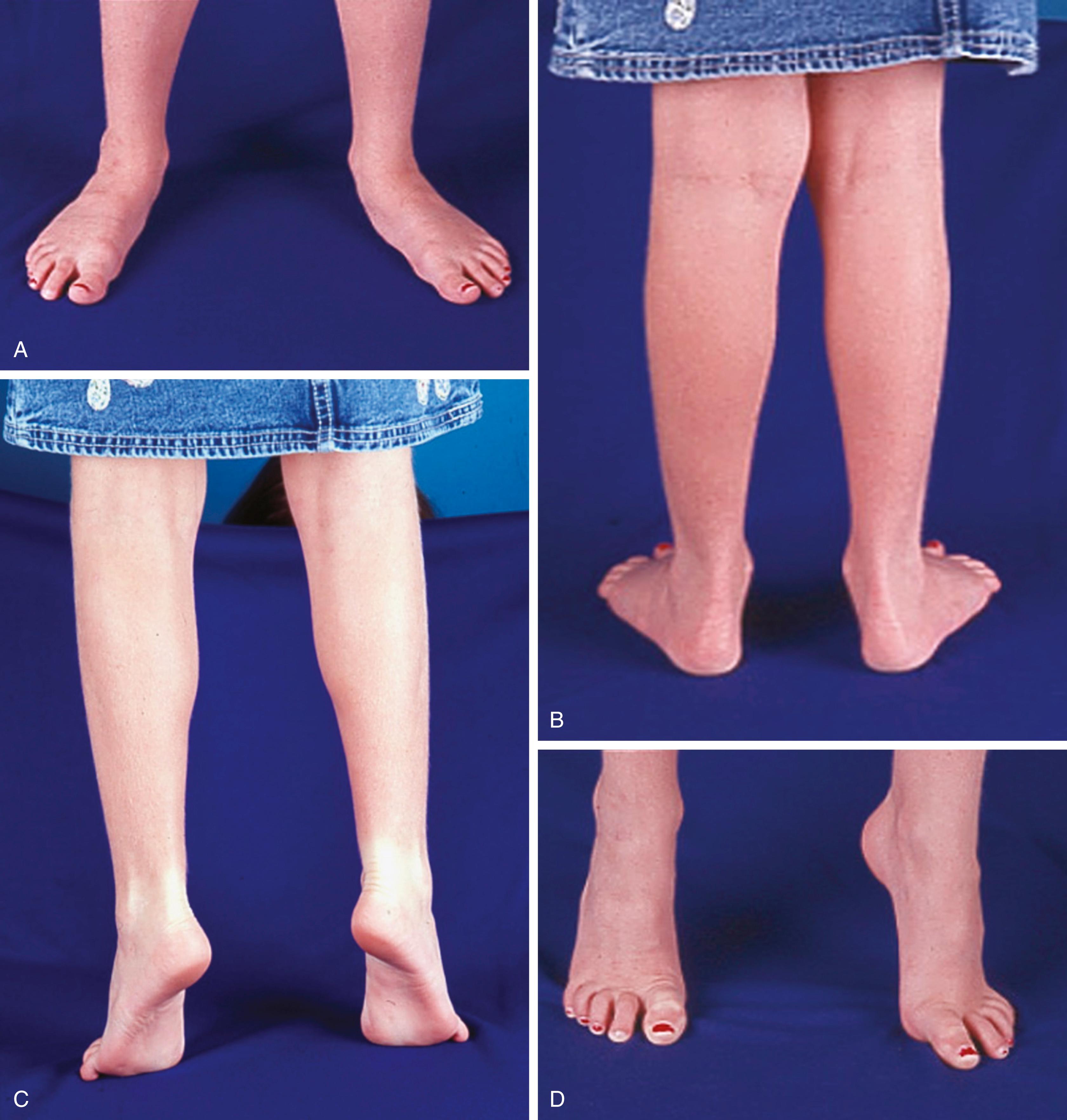 FIG. 19.28, Flexible flatfoot. (A–D) Reconstitution of the longitudinal arch and inversion of the heels during tiptoe standing, the hallmarks of flexible pes planovalgus.