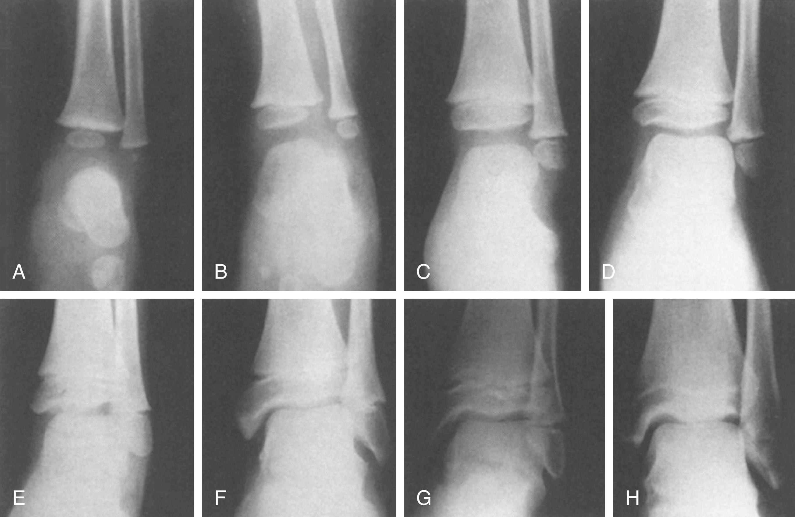 FIG. 19.3, Ossification of the distal epiphyses of the tibia and fibula. (A) One-year old; (B) 2 years; (C) 4 years; (D) 6 years; (E) 7 years; (F) 10 years; (G) 12 years; (H) adult.