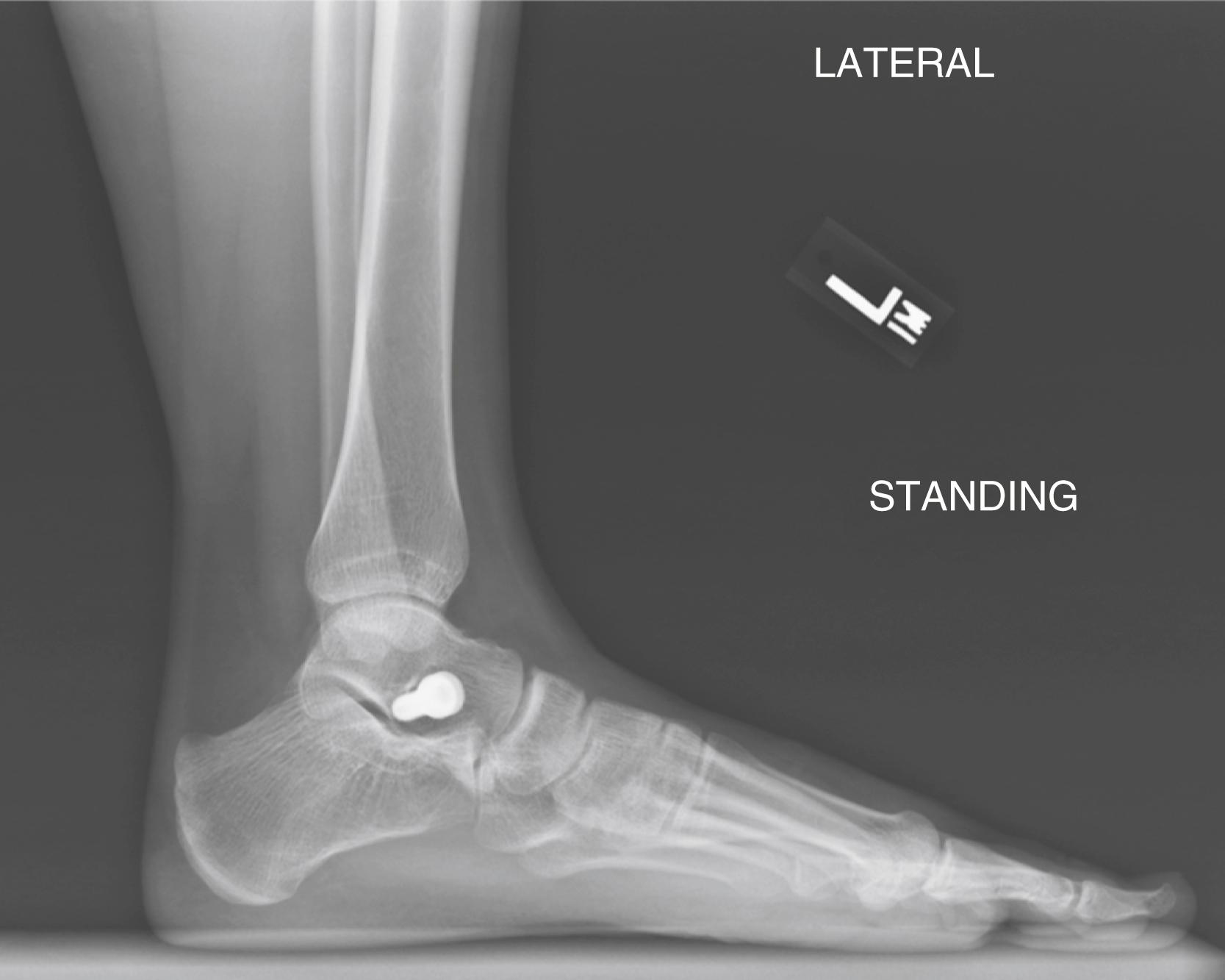 FIG. 19.32, Lateral radiograph of a subtalar arthroereisis screw, which was removed due to unrelenting subtalar pain.