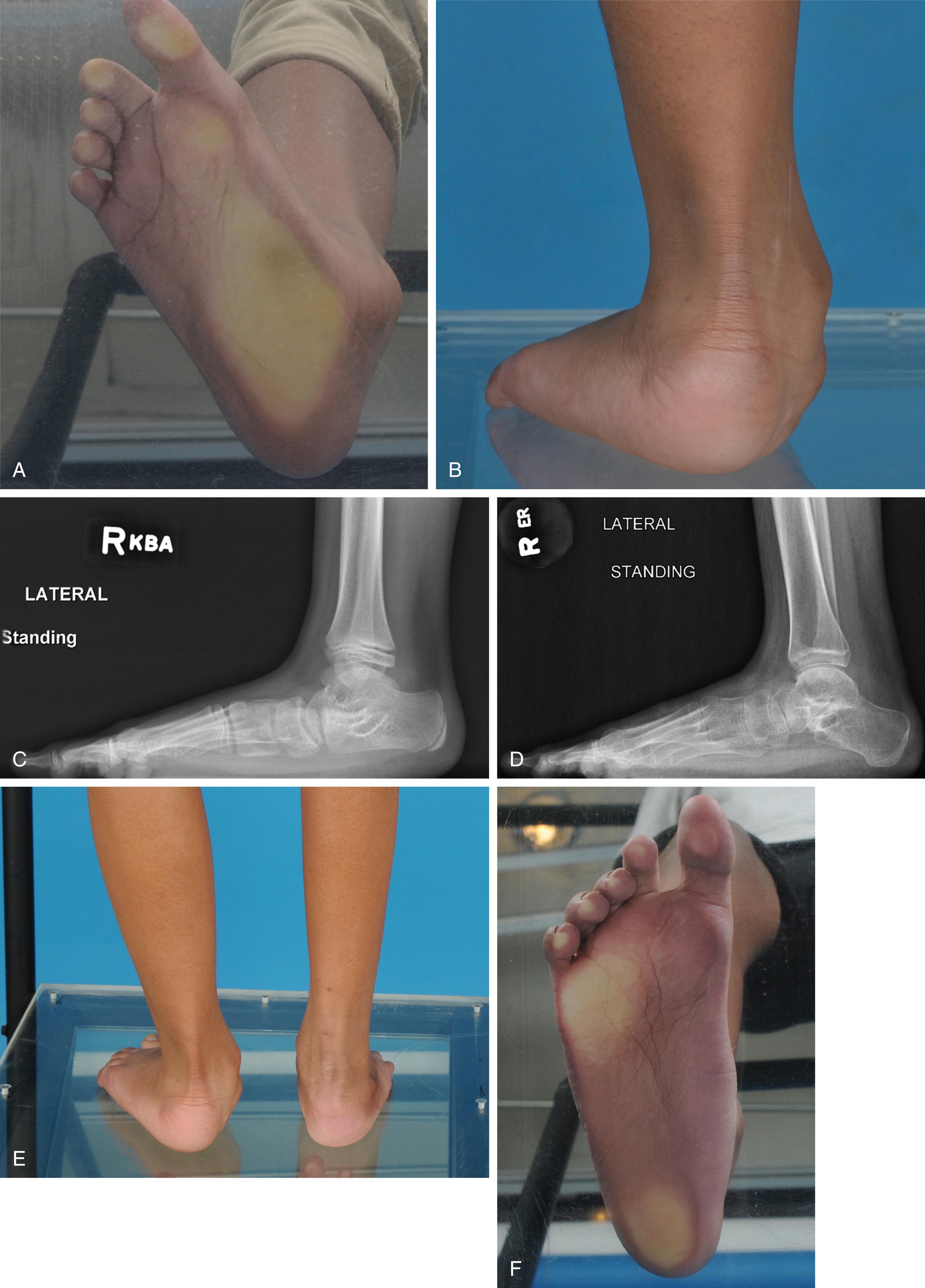 FIG. 19.33, Painful flatfoot in a 12-year-old girl. (A) Posterior view shows marked hindfoot valgus. (B) Plantar view shows abnormal medial plantar pressure distribution. (C) Preoperative lateral radiograph showing naviculocuneiform sag. (D) Postoperative radiograph following a right-sided calcaneal lengthening and medial imbrication procedure showing restoration of Meary angle. (E) Postoperative posterior view shows improved hindfoot alignment. (F) Postoperative plantar view shows a normalized plantar pressure pattern.