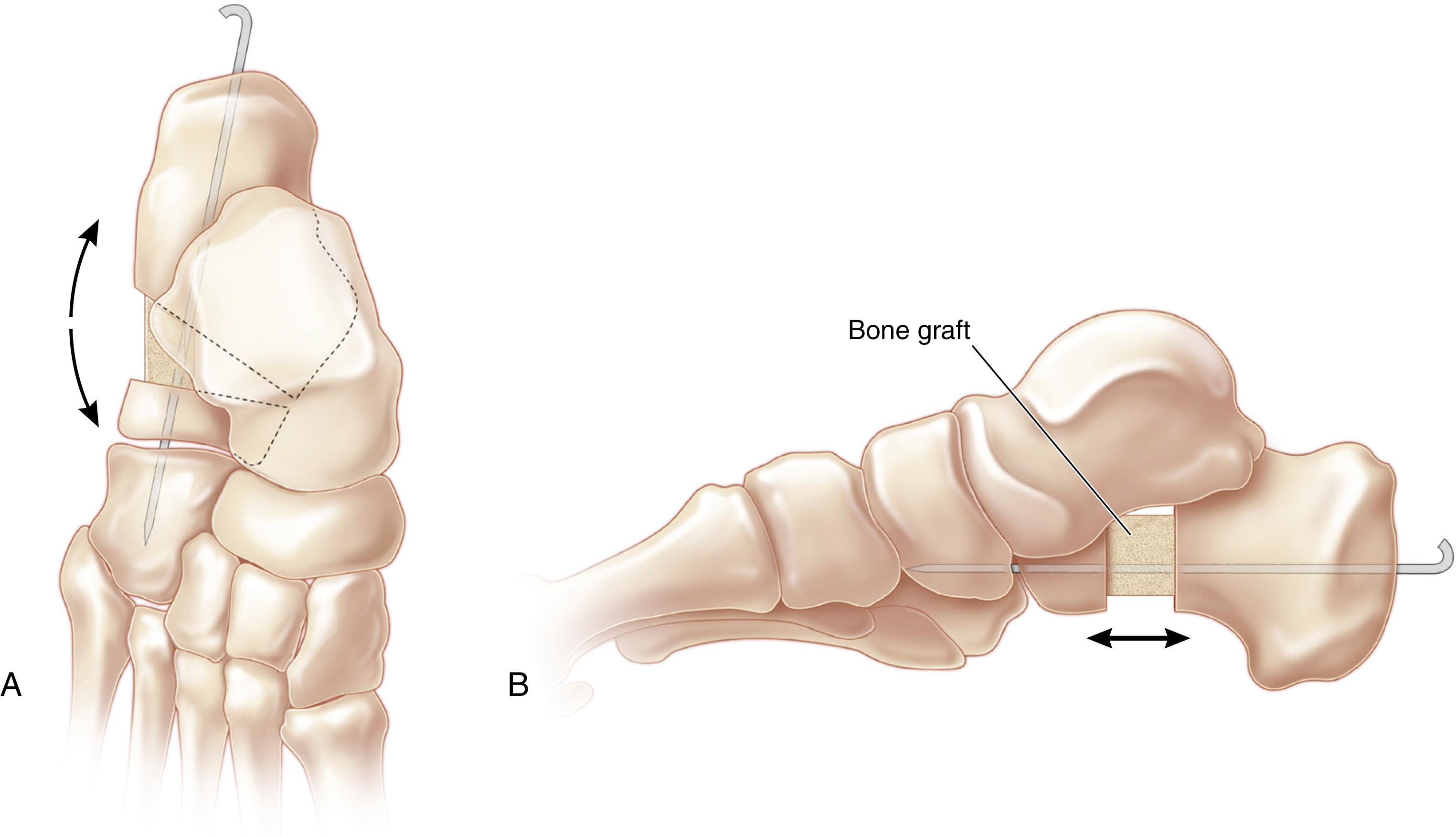 FIG. 19.34, Dorsal view (A) and lateral view (B) of lateral column lengthening to treat flatfoot. K-wire fixation can be useful to prevent displacement of both the graft and the distal osteotomy fragment.