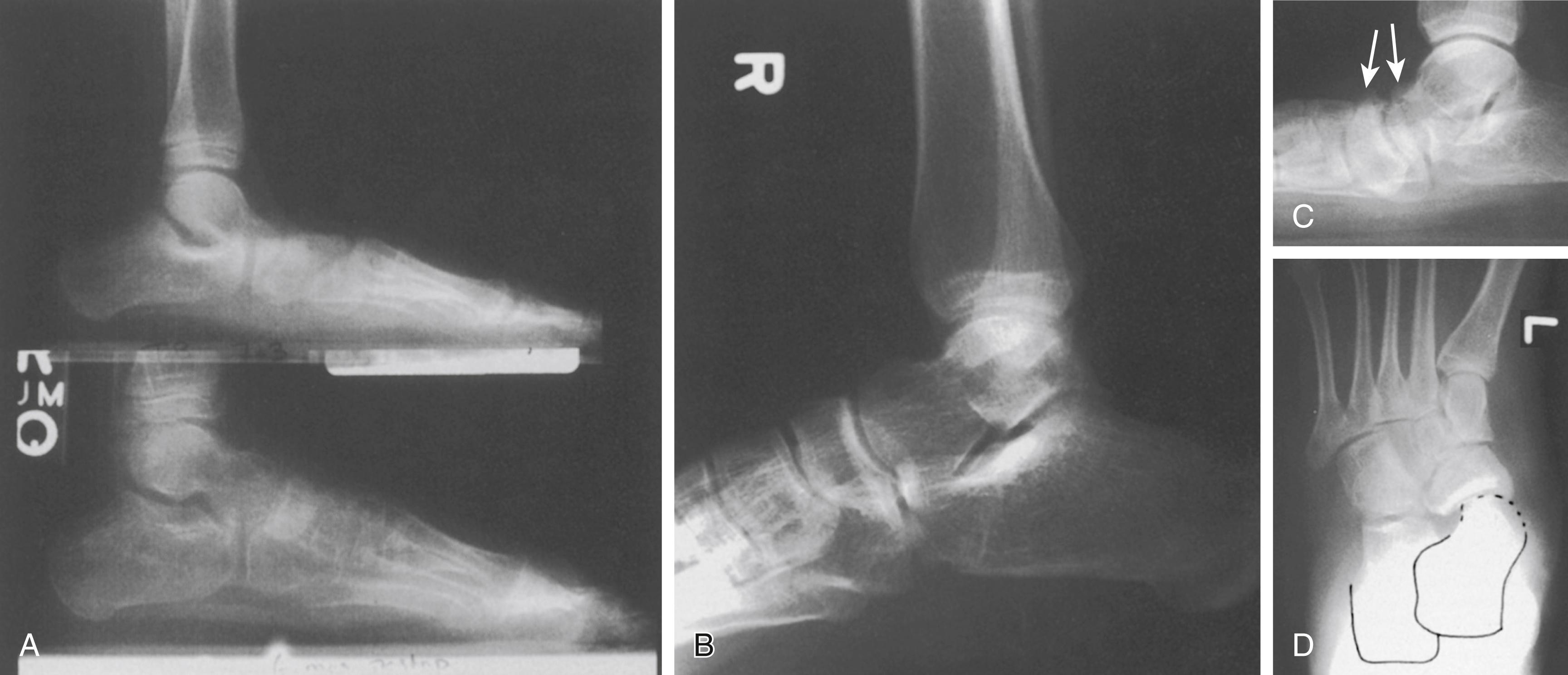 FIG. 19.37, Result of medial imbrication/calcaneal sliding osteotomy. (A) Lateral radiographs of both feet of the patient (see Fig. 19.27 ) 6 months after correction of the right foot (bottom). The talonaviculocuneiform axis is normally aligned. (B) Lateral radiograph of the right foot obtained at 10-year follow-up. The correction is maintained and the foot is asymptomatic. (C and D) The left foot of the same patient, which was not operated on. Note the arthritic changes in the talonavicular joint ( arrows in C). This foot was only mildly symptomatic and was never treated surgically, although the degenerative changes provoke some concern.