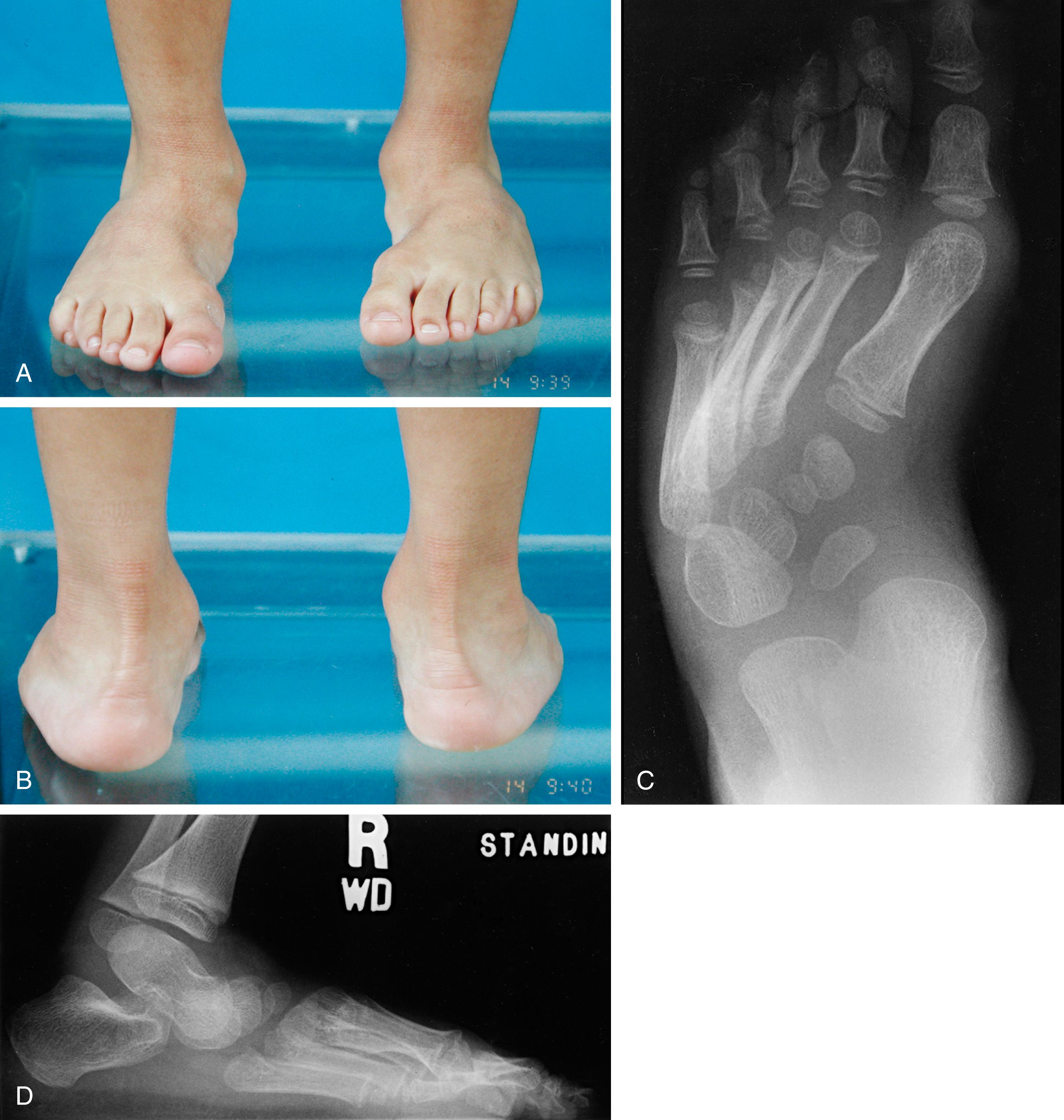 FIG. 19.38, (A) Photograph of a child with skewfoot and a moderate degree of forefoot adduction. (B) Posterior view showing increased valgus of the heel. (C) Anteroposterior radiograph of a skewfoot showing marked adductus of the metatarsals with lateral subluxation of the navicular. (D) Lateral radiograph showing an increased talocalcaneal angle indicative of valgus of the hindfoot.