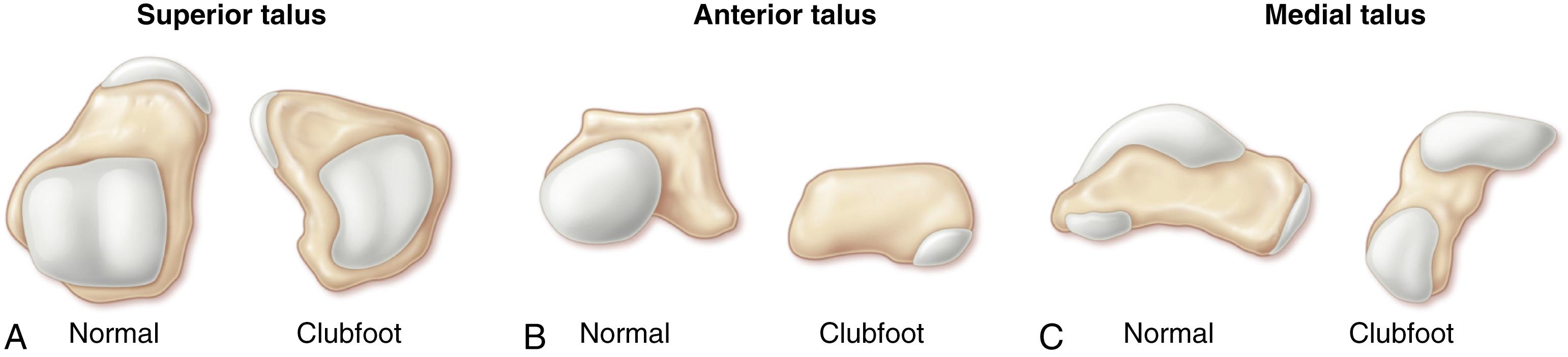 FIG. 19.39, Schematic illustration of a clubfoot talus. (A) Top view. The neck is shortened and deviated medially, so true distinction from the body of the talus is questionable. The articulation with the navicular is on the medial side of the misshapen talar head. (B) End-on view. The medial and plantar deviation of the navicular articulation is apparent. (C) Equinus of the neck in relation to the tibiotalar articular surface is significant. 6