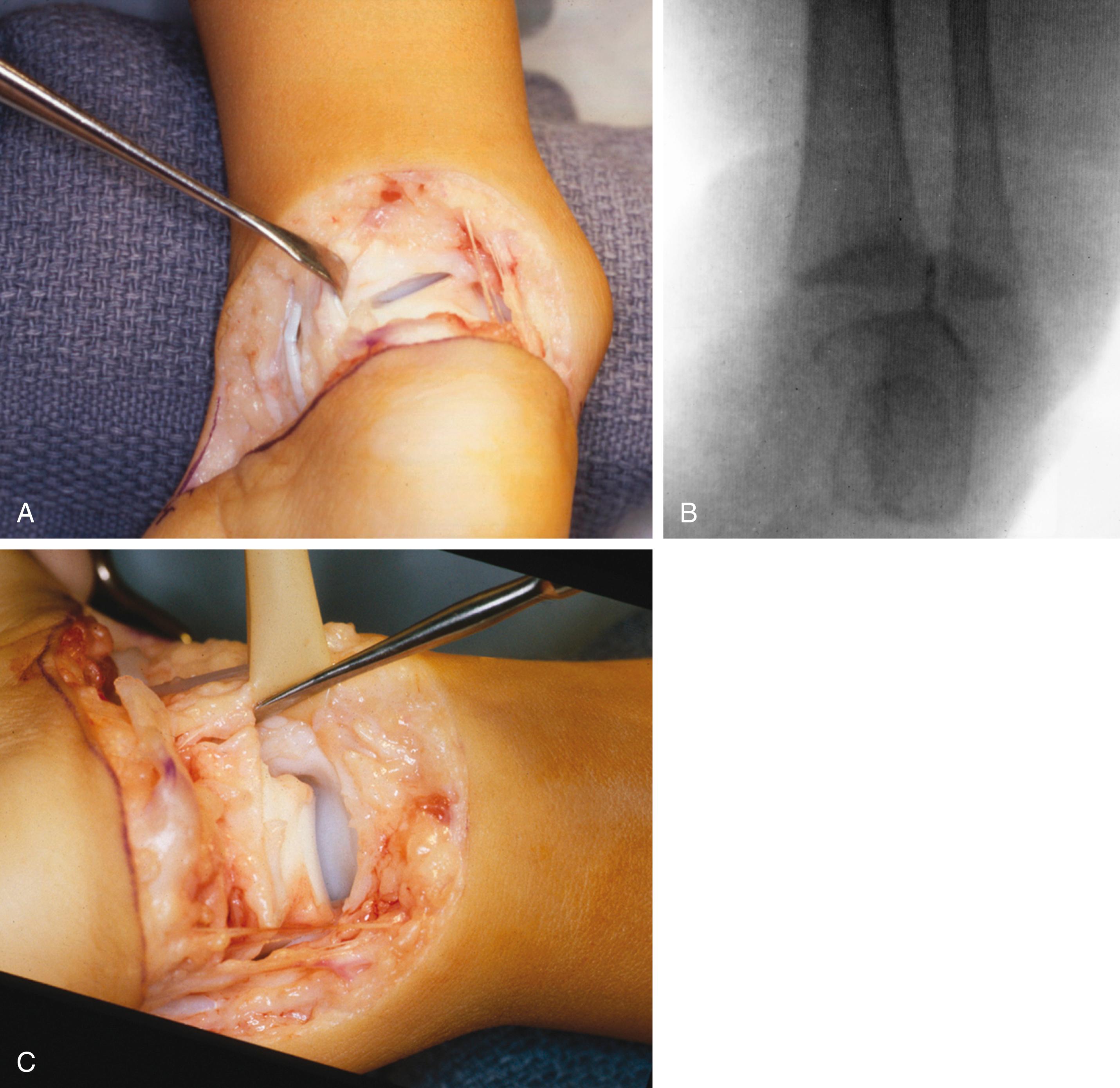 FIG. 19.41, The pronation or intorsion deformity. (A) Appearance at surgery (posterior view, medial malleolus to the left ). The talar articular surface is rotated counterclockwise (“intorsion”) toward the medial malleolus. Supination and varus of the heel can be seen. (B) Arthrographic documentation of talar pronation. (C) Correction after release of the most posterior connections of the talus to the medial malleolus (“posterior” deltoid ligament). The neurovascular bundle is retracted. The nonarticular deltoid ligament between the medial malleolus and the talar body is preserved. The talar articular surface is now perpendicular to the long axis of the tibia.