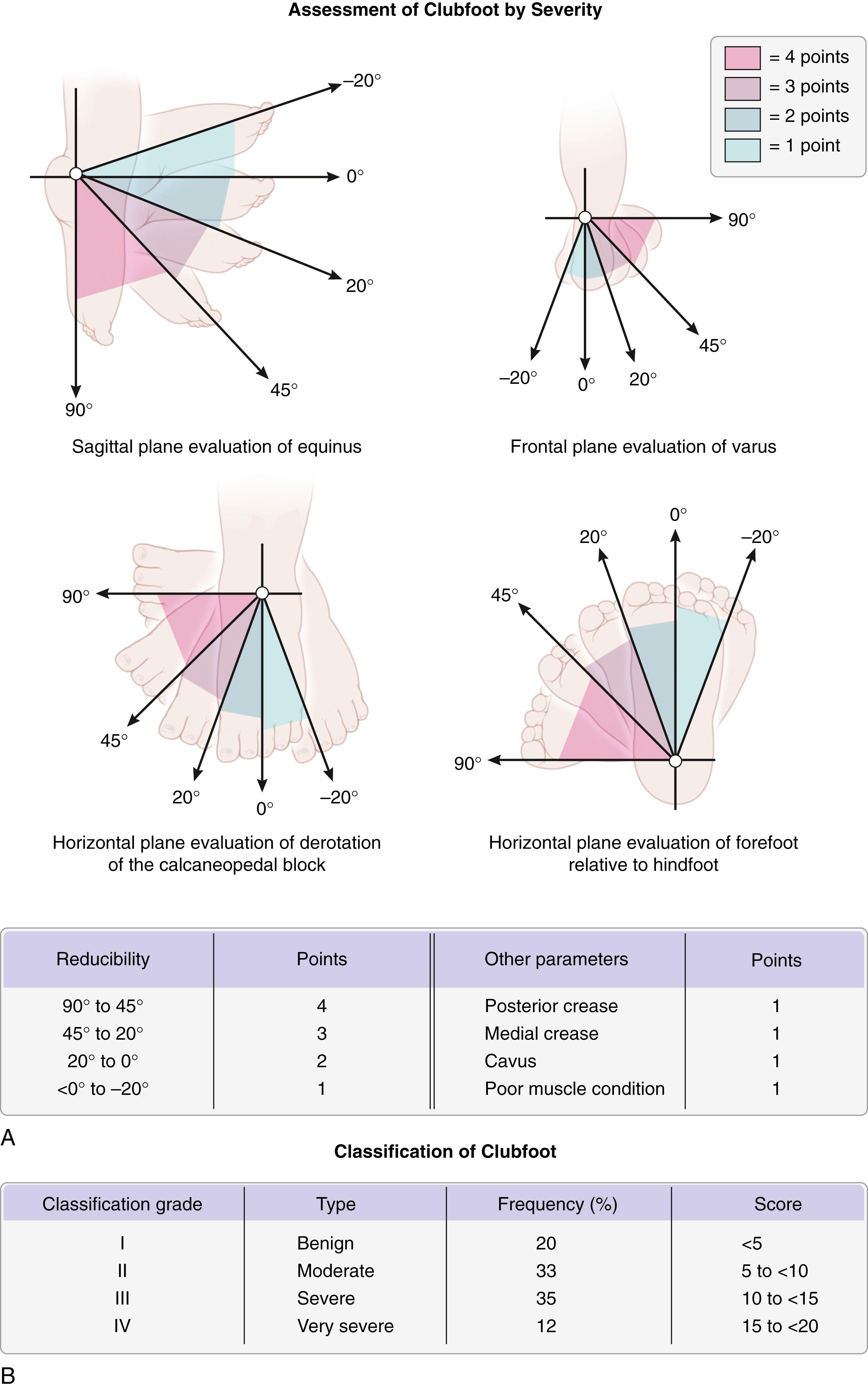 FIG. 19.43, Classification of clubfoot according to Dimeglio. (A) Assessment of clubfoot by severity. Each major component of clubfoot (equinus, heel varus, medial rotation of the calcaneo-pedal “block,” and forefoot adductus) is graded clinically from 4 to 1 (most severe to most mild). Additional points are added for deep posterior and medial creases, cavus, and poor muscle function. (B) Classification of clubfoot. The total score is stratified into four groups of severity (benign to very severe, grades I–IV).