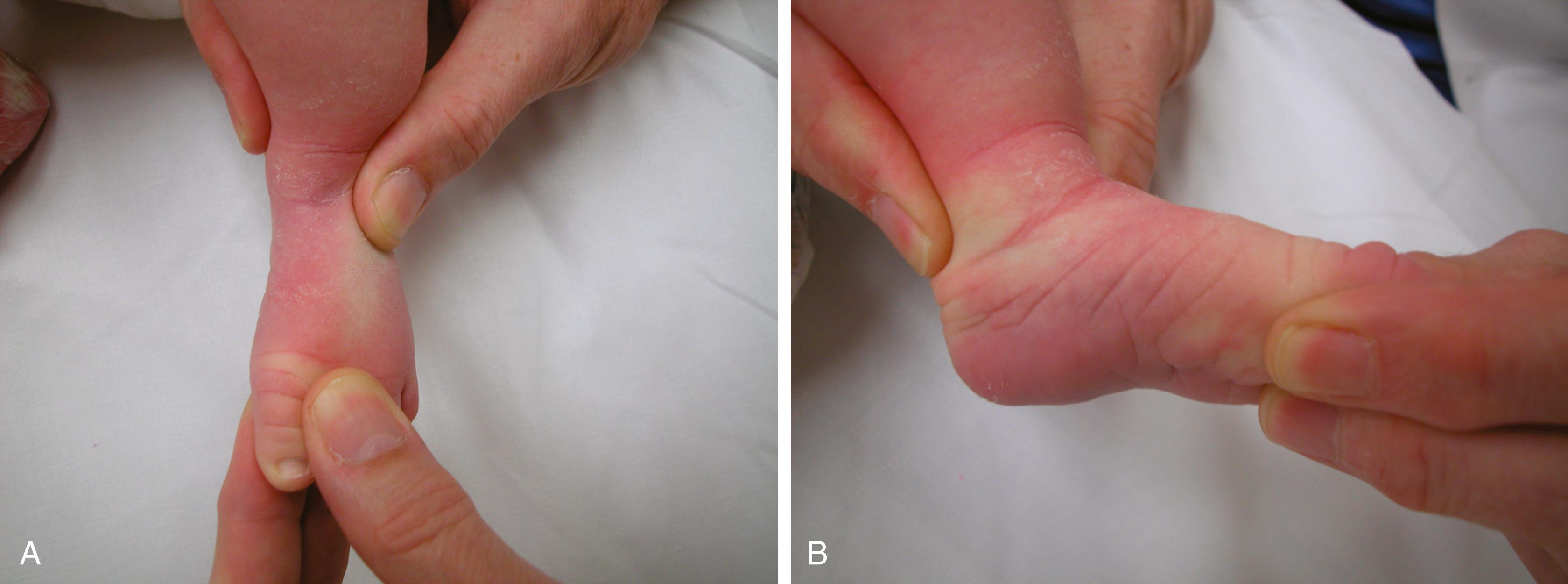 FIG. 19.45, Technique of a nonoperative Ponseti correction of clubfoot. (A) The thumb is positioned over the lateral aspect of the head of the talus and the fingers correct the forefoot. No counterpressure should be applied at the calcaneocuboid joint because the entire foot must be abducted under the talus. (B) The cavus and adduction are corrected by slight supination of the forefoot in relation to the hindfoot. The forefoot is never everted; rather, it is displaced as a unit.