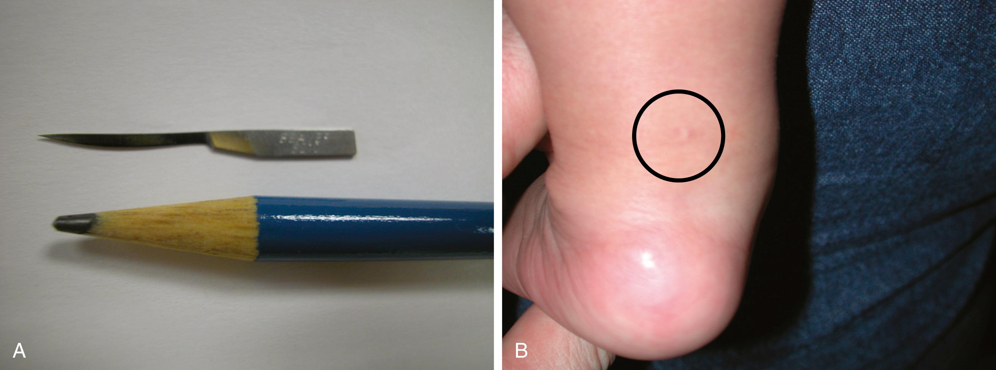 FIG. 19.46, (A) Thin cataract knife blade used for percutaneous heel cord tenotomy. (B) Little scarring is left.